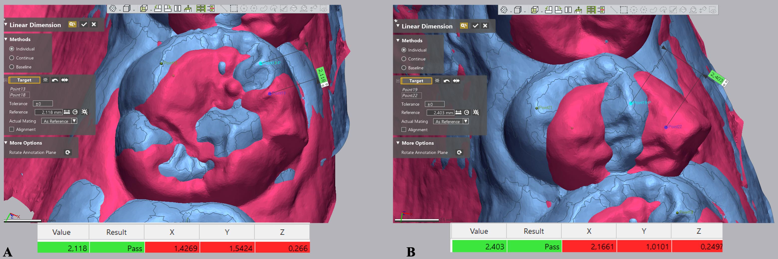 Linear measurements on superimposed digital models. (A) Displacement of the mesiobuccal cusp of the maxillary molar on the (transversal), Y-axis (sagittal) and Z-axis (vertical). (B) Displacement 
of the buccal cusp of the maxillary second premolar on the X-axis (transversal), 
Y-axis (sagittal) and Z-axis (vertical). Blue, pretreatment-reference model 
(T0); Pink, achieved outcome-measured model (T1).