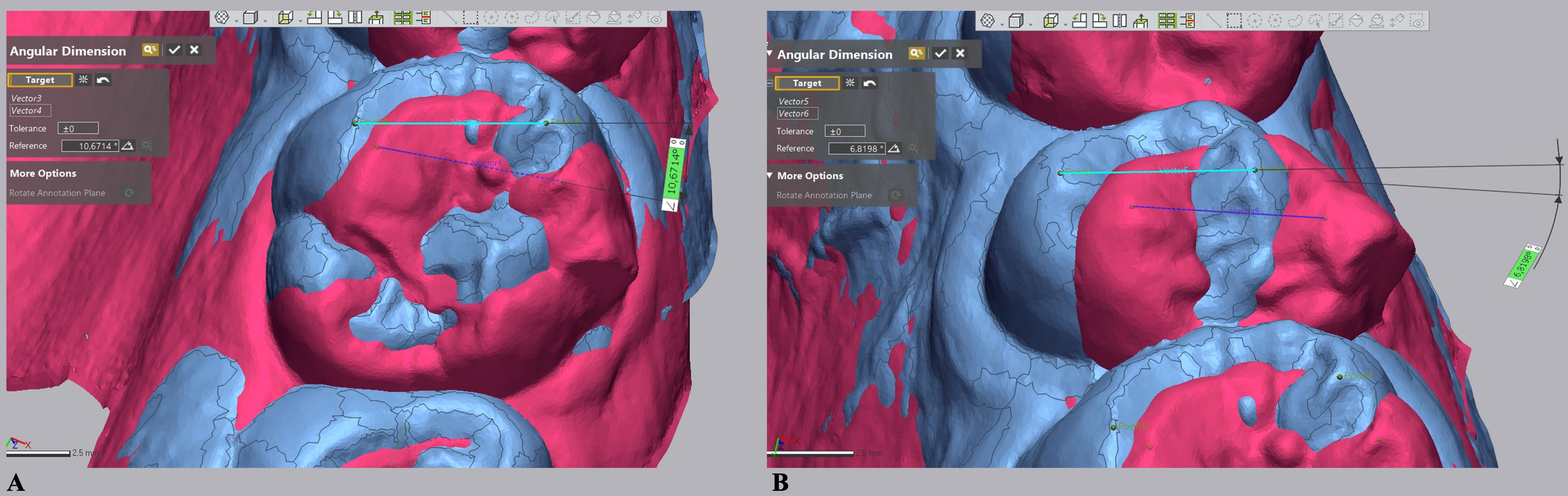Angular measurements on superimposed digital models. (A) Vectors created by combining the mesiobuccal and 
mesiopalatinal cusp tips used to measure molar rotation. (B) Vectors 
created by combining the buccal and palatinal cusp tips used to measure premolar 
rotation. Blue, pretreatment-reference model (T0); Pink, achieved 
outcome-measured model (T1).