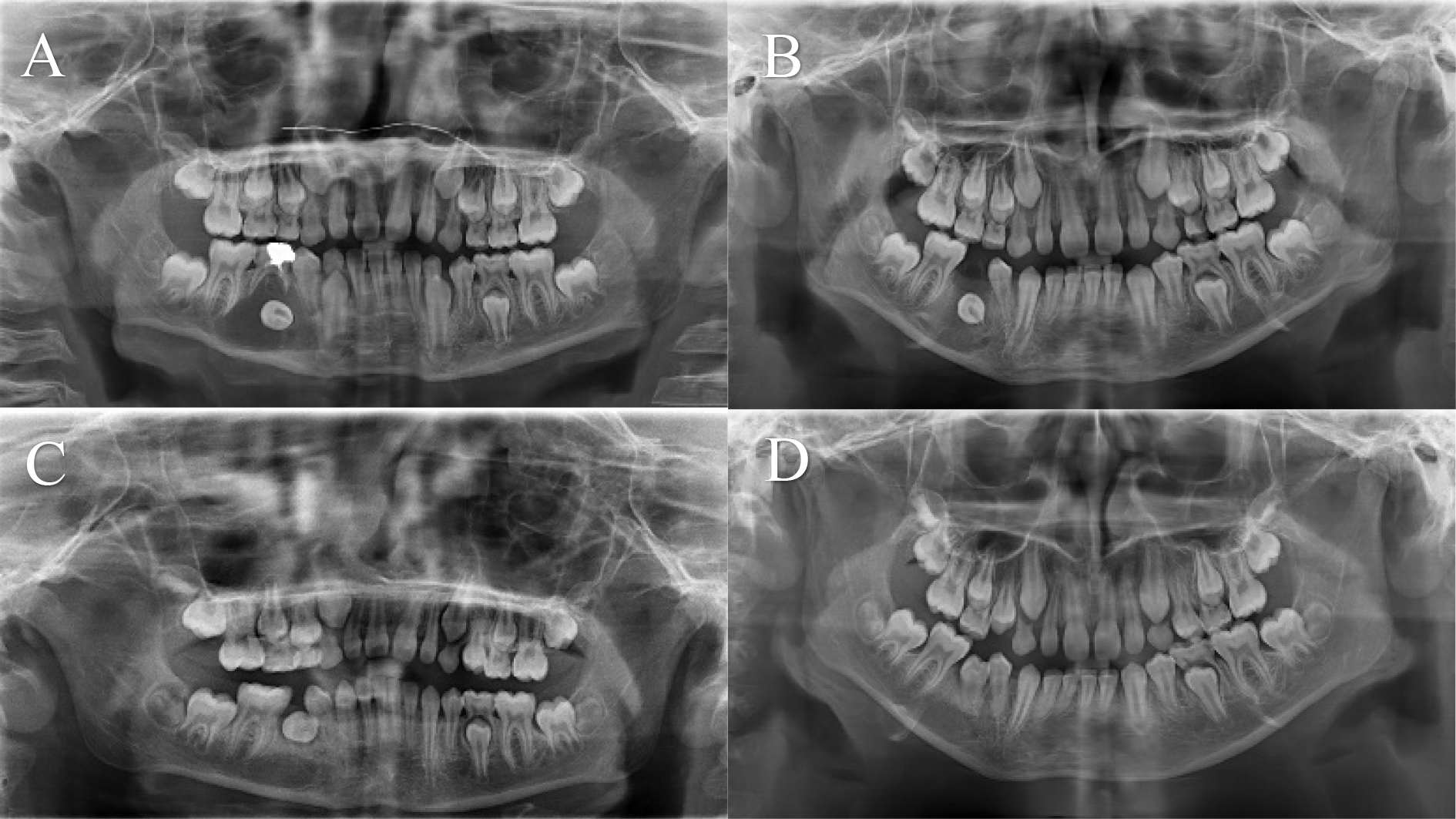Case 1: panoramic radiographic findings during treatment. (A)
Pre-operative. (B) Post-operative 3-month follow-up. (C) Post-operative 6-month
follow-up. (D) Post-operative 12-month follow-up.