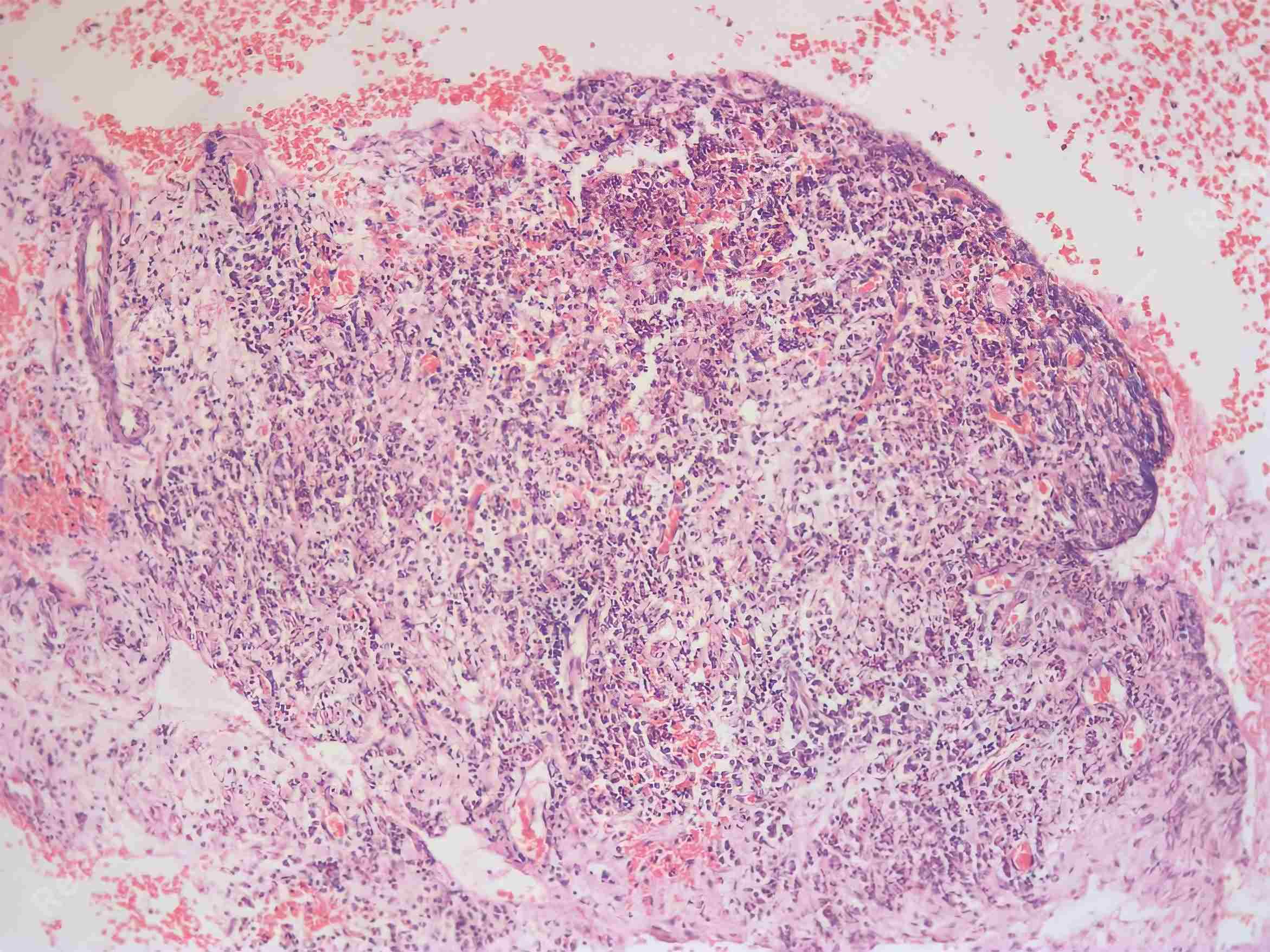 Case 1: histological examination. Collagenized connective
tissue with dense mononuclear inflammatory cell infiltration beneath a thin,
non-keratinized odontogenic epithelium was shown (hematoxylin & eosin,
×100 magnification).