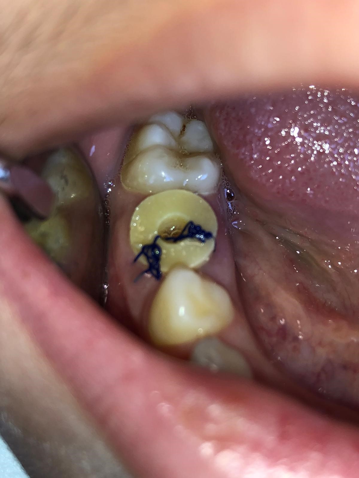 Surgical drain. Placement of a surgical drain in the extraction
socket for decompression therapy.
