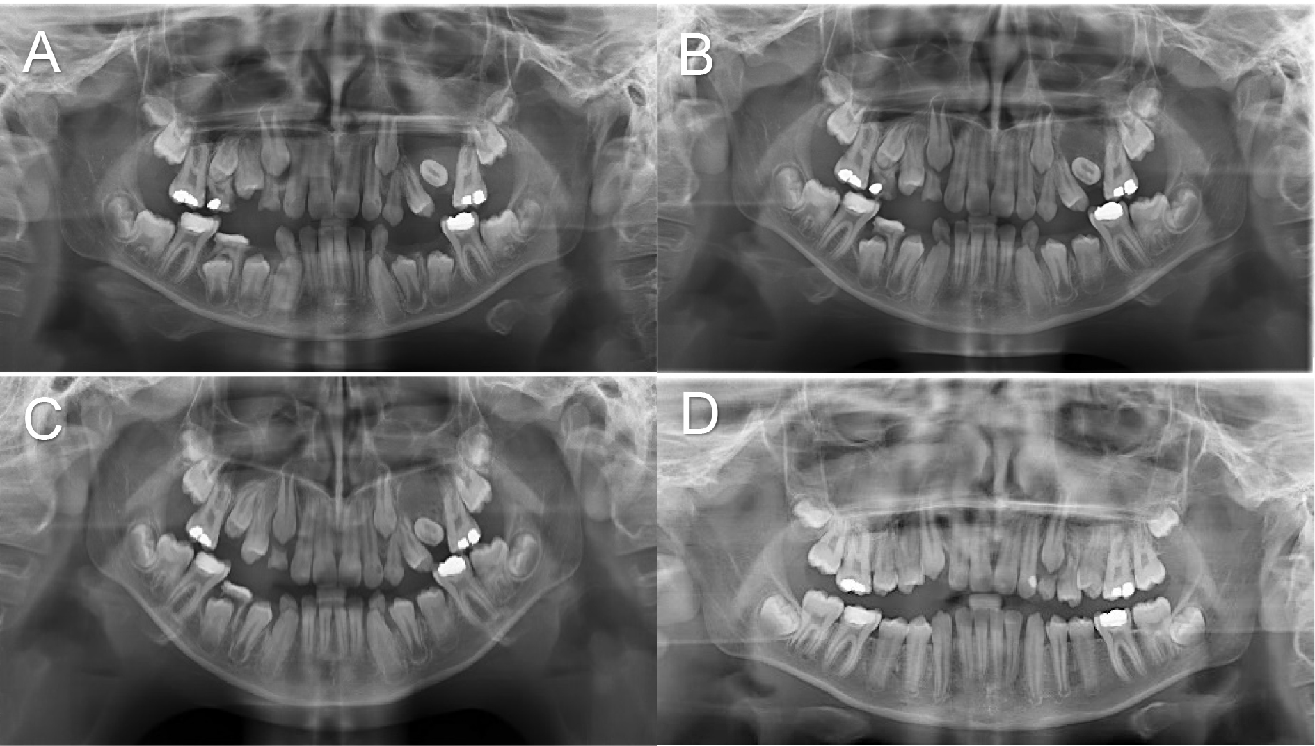 Case 2: panoramic radiographic findings during treatment. (A)
Pre-operative. (B) Post-operative 3-month follow-up. (C) Post-operative 6-month
follow-up. (D) Post-operative 12-month follow-up.