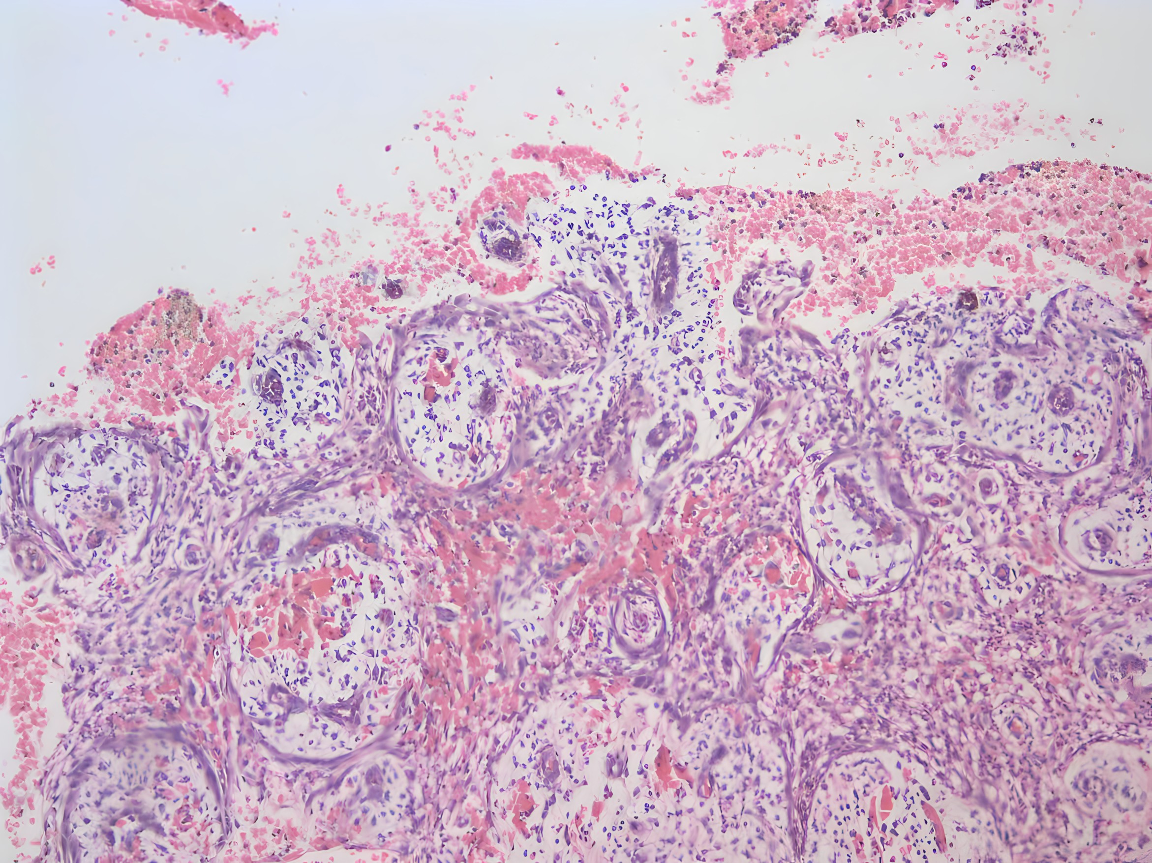 Case 2: histological examination. Collagenized connective
tissue with dense mixed inflammatory cell infiltration beneath a non-keratinized
odontogenic epithelium was shown (hematoxylin & eosin, ×100
magnification).