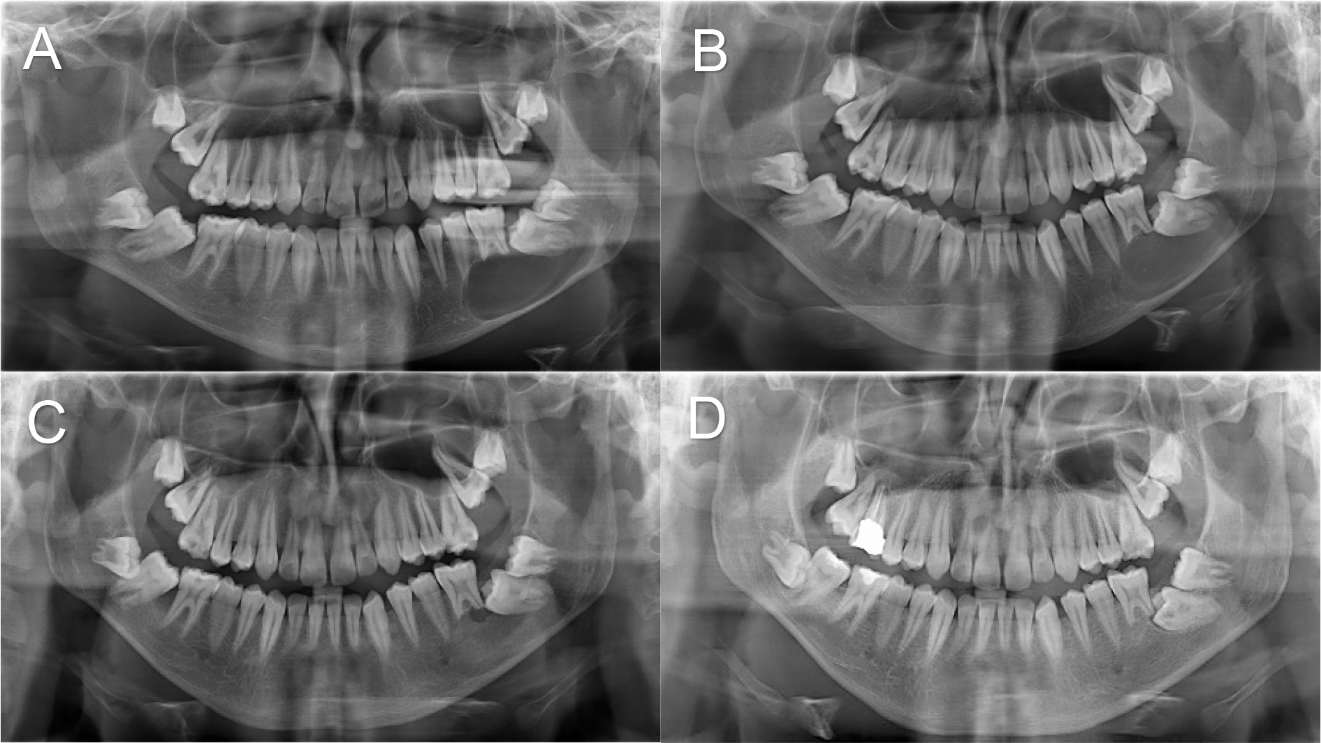 Case 3: panoramic radiographic findings during treatment. (A)
Pre-operative. (B) Post-operative 3-month follow-up. (C) Post-operative 6-month
follow-up. (D) Post-operative 12-month follow-up.