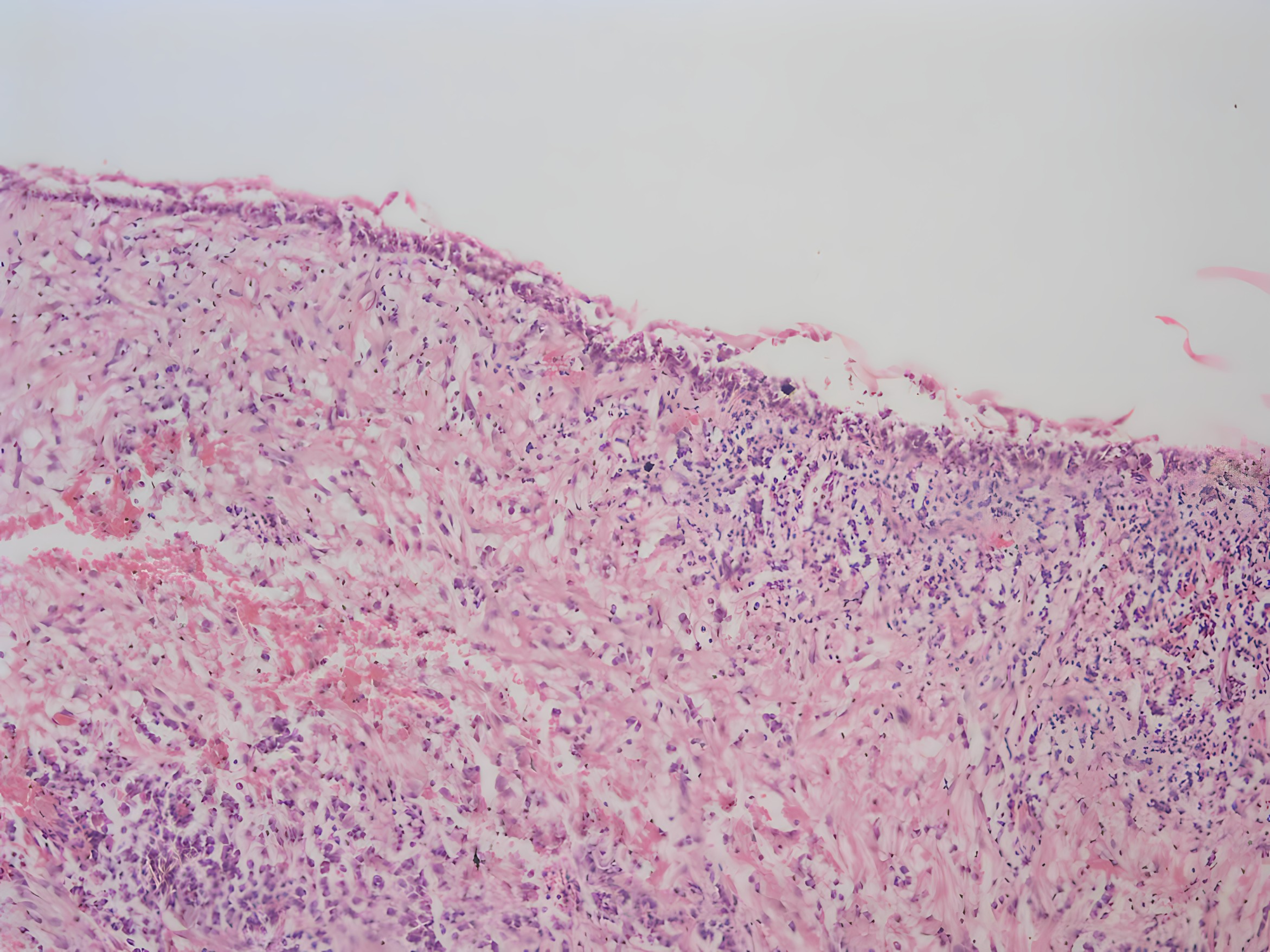 Case 3: histological examination. Collagenized connective
tissue with focal mononuclear inflammatory cell infiltration beneath a thin,
non-keratinized odontogenic epithelium was shown (hematoxylin & eosin,
×100 magnification).
