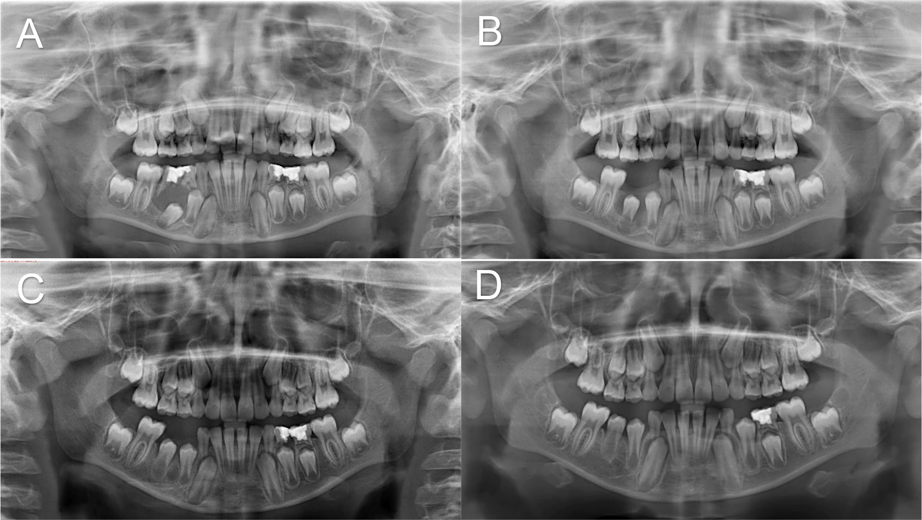Case 4: panoramic radiographic findings during treatment. (A)
Pre-operative. (B) Post-operative 3-month follow-up. (C) Post-operative 6-month
follow-up. (D) Post-operative 12-month follow-up.