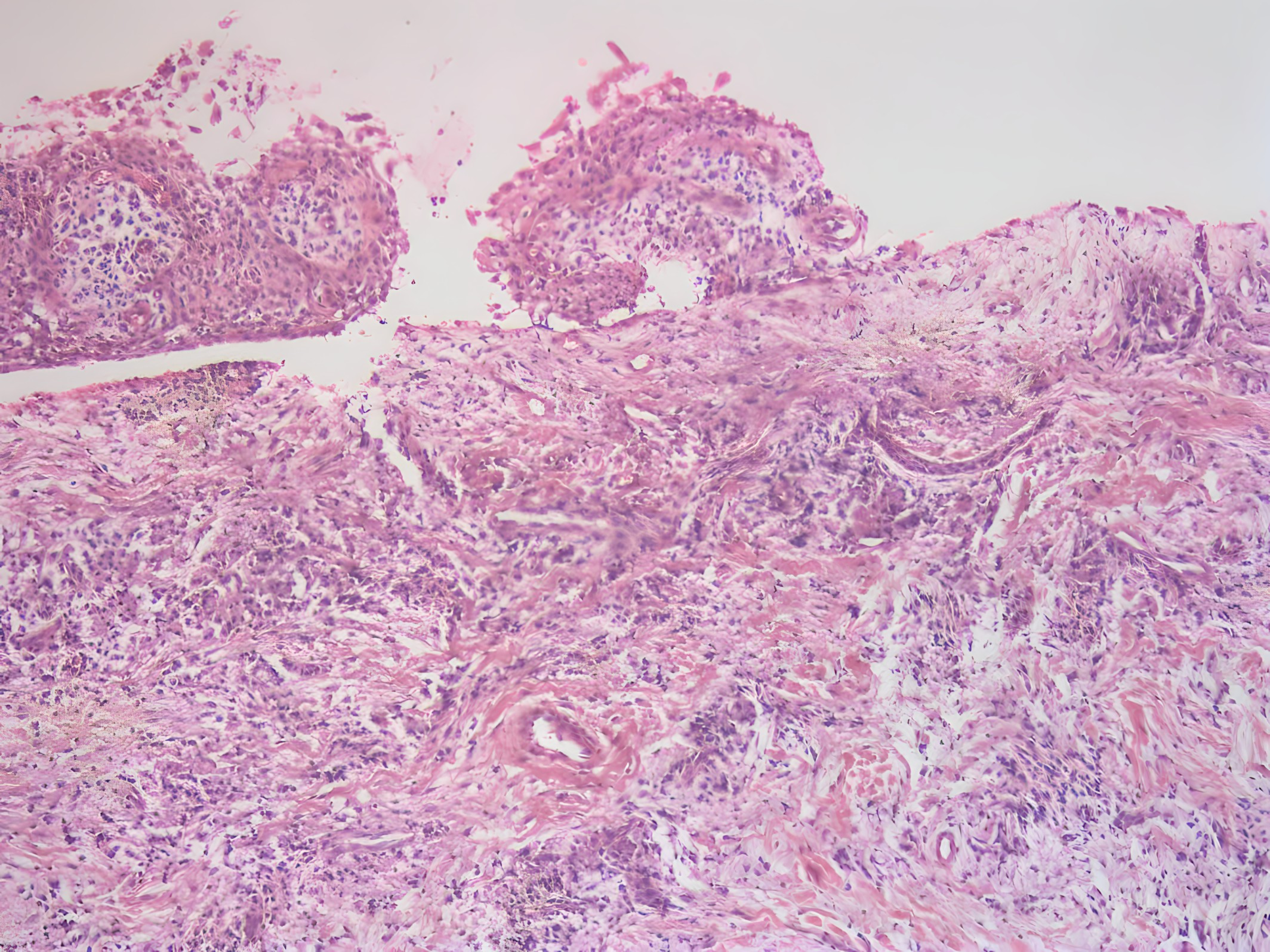 Case 4: Histological examination. Collagenized connective
tissue with dense mononuclear inflammatory cell infiltration situated beneath a
non-keratinized odontogenic epithelium was shown (hematoxylin & eosin,
×100 magnification).
