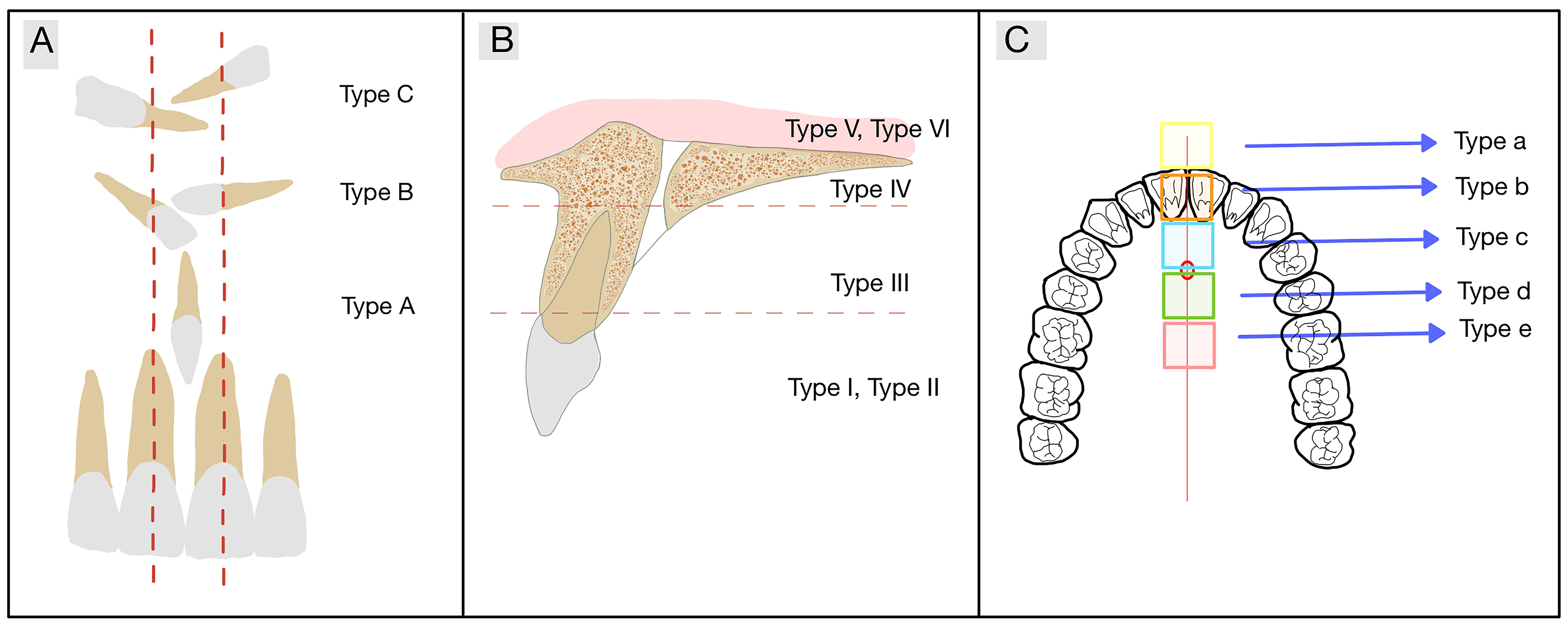 Schematization of the mesiodens classification. (A) Illustration 
of the mesiodens classification in the frontal plane. (B) Illustration of the 
mesiodens classification in the sagittal plane. (C) Illustration of the mesiodens 
classification in the axial plane.