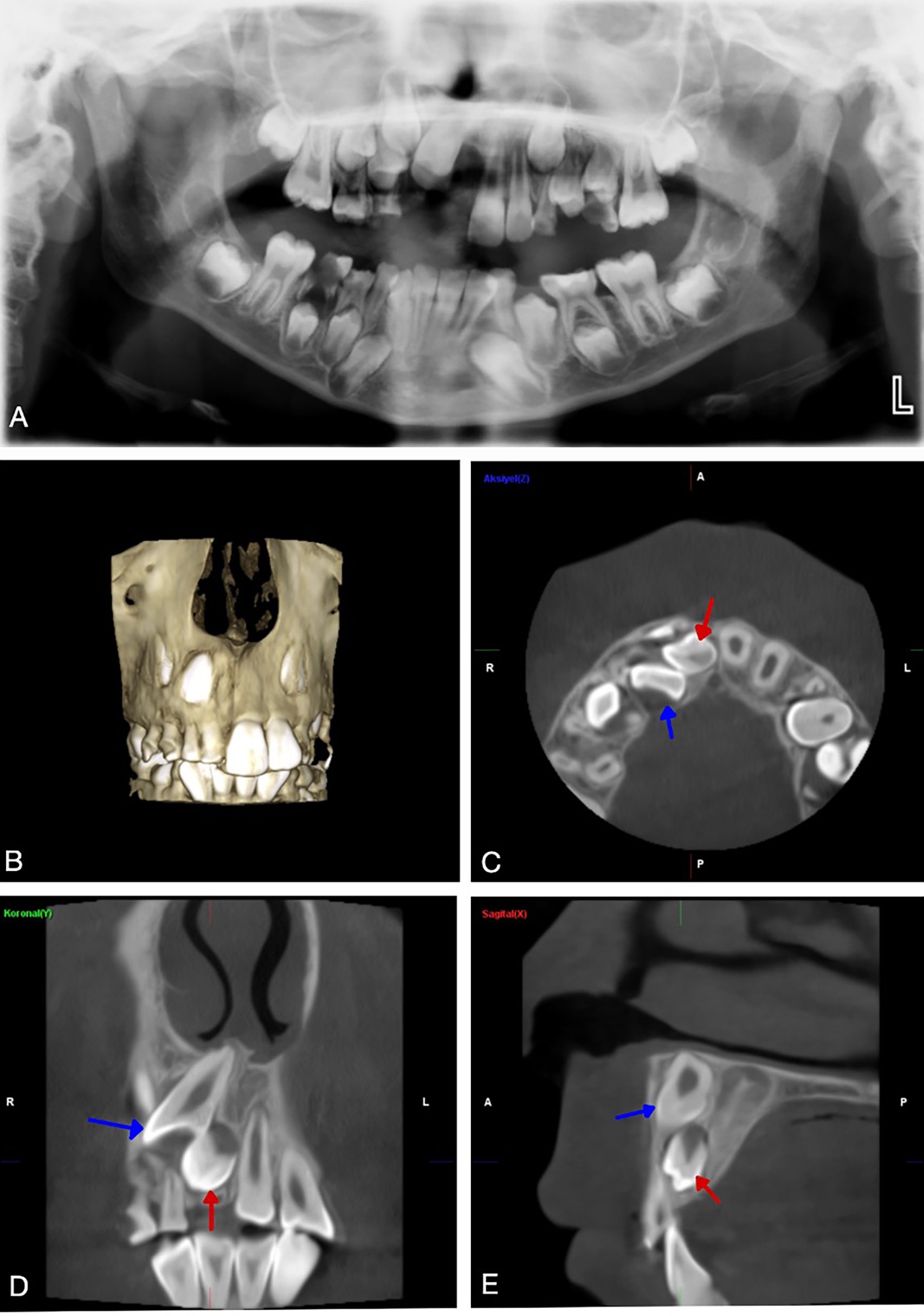 Radiographs of a sample case showing mesiodens causing eruption 
problems in permanent teeth. (A) Panoramic radiographic image. The position of 
the mesiodens could not be clearly observed. (B) 3D reconstruction image. (C) 
Axial CBCT image. Mesiodens was observed to the right of the midline. (D) Coronal 
CBCT image. (E) Sagittal CBCT image (blue arrows pointed to tooth #11, red 
arrows pointed to mesiodens).