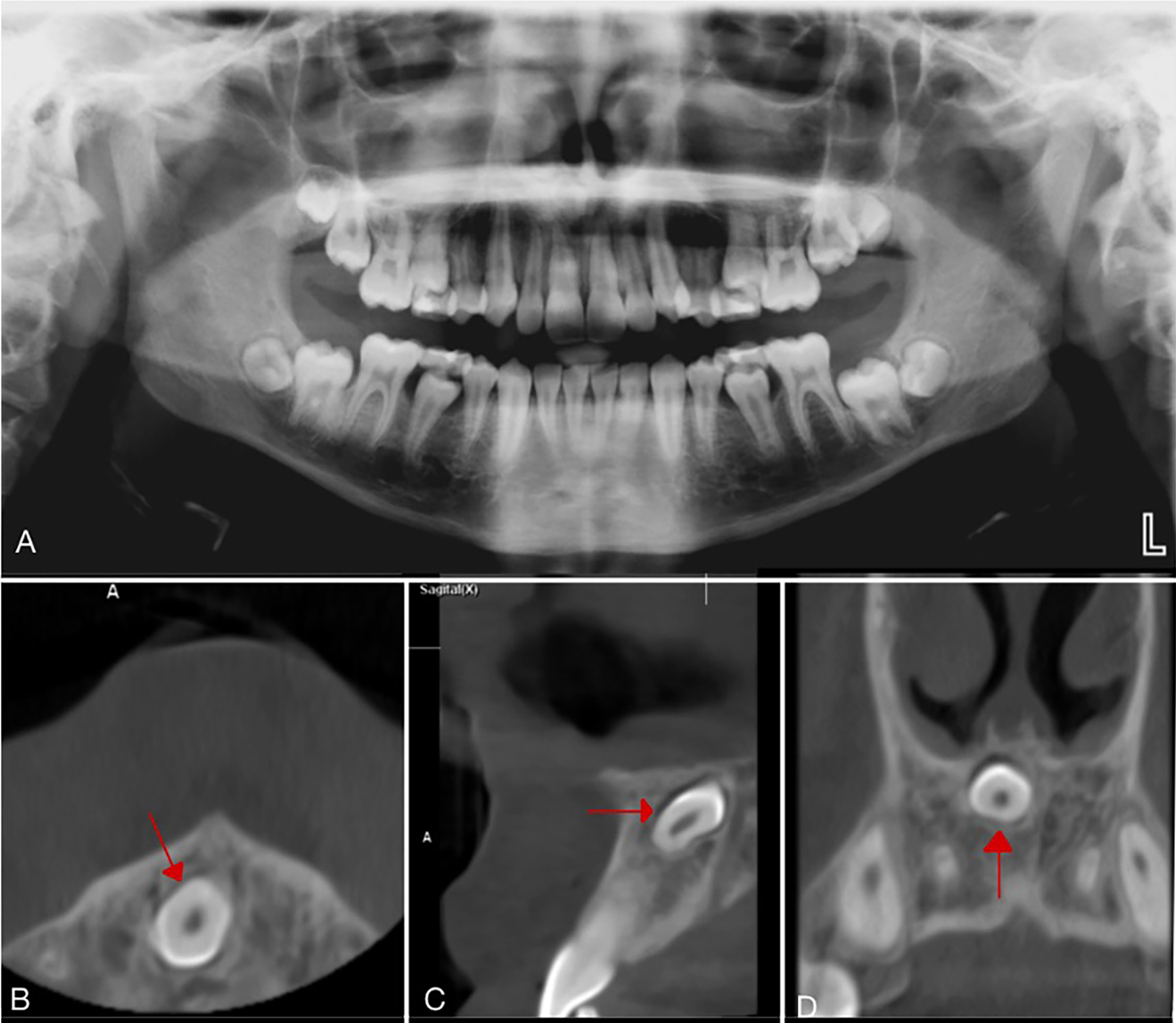 Radiographs of a sample case showing mesiodens without 
complications in permanent teeth. (A) Panoramic radiographic image. Mesiodens 
could not be observed clearly due to superposition of the hard palate. (B) Axial 
CBCT image. Mesiodens was observed in the midline inverted position. (C) Sagittal 
CBCT image. (D) Coronal CBCT image (red arrows pointed to mesiodens).