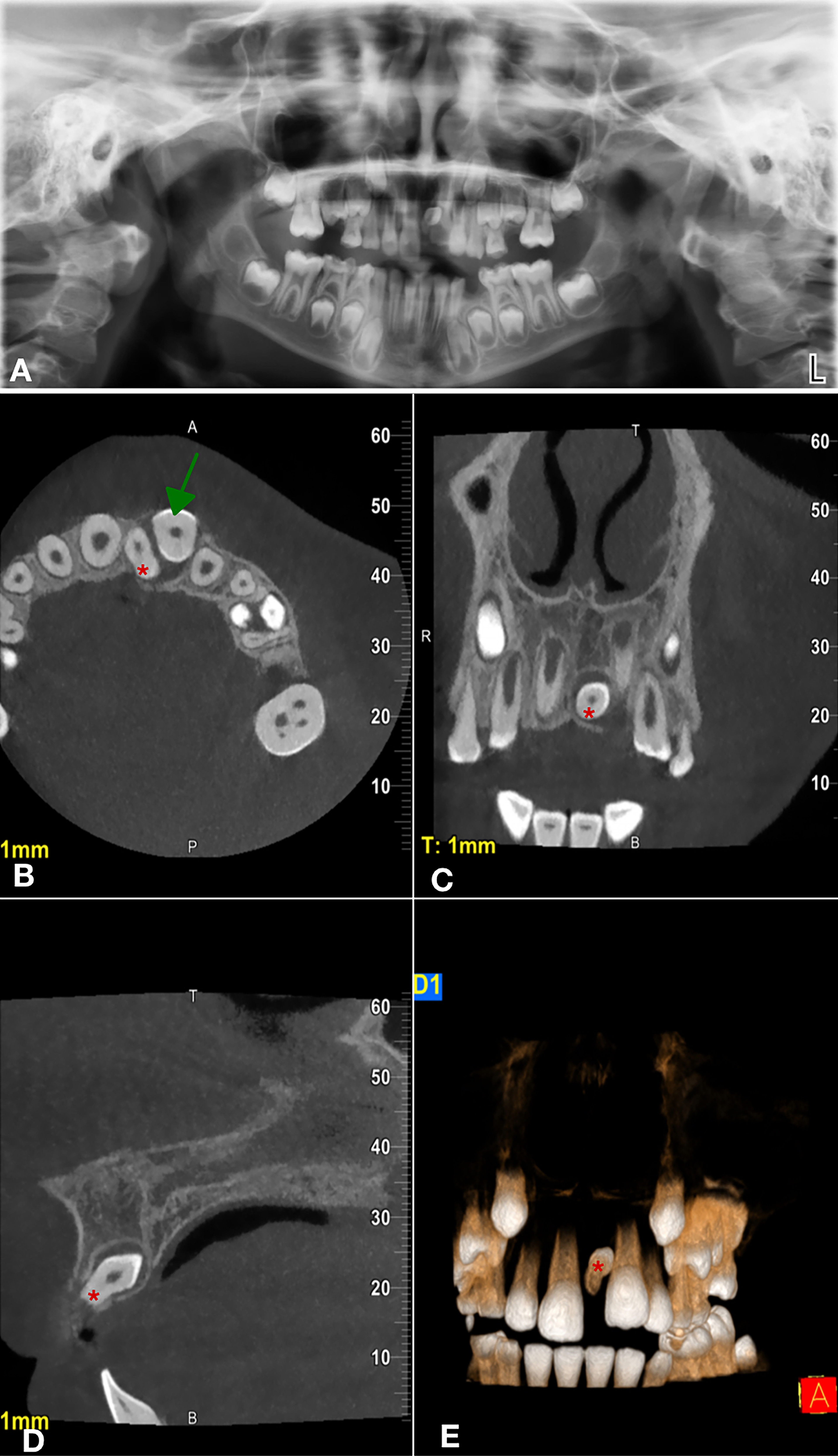 Radiographs of a sample case showing mesiodens causing 
complications in permanent teeth. (A) Panoramic radiographic image. Mesiodens was 
observed in the midline. (B) Axial CBCT image. Eruption problems and hyperplastic 
follicle were observed in tooth number #21. (C) Coronal CBCT image. (D) Sagittal 
CBCT image. Mesiodens was observed in the midline inverted position. (E) 3D 
reconstruction image (green arrows pointed to tooth #21, red stars pointed to 
mesiodens).
