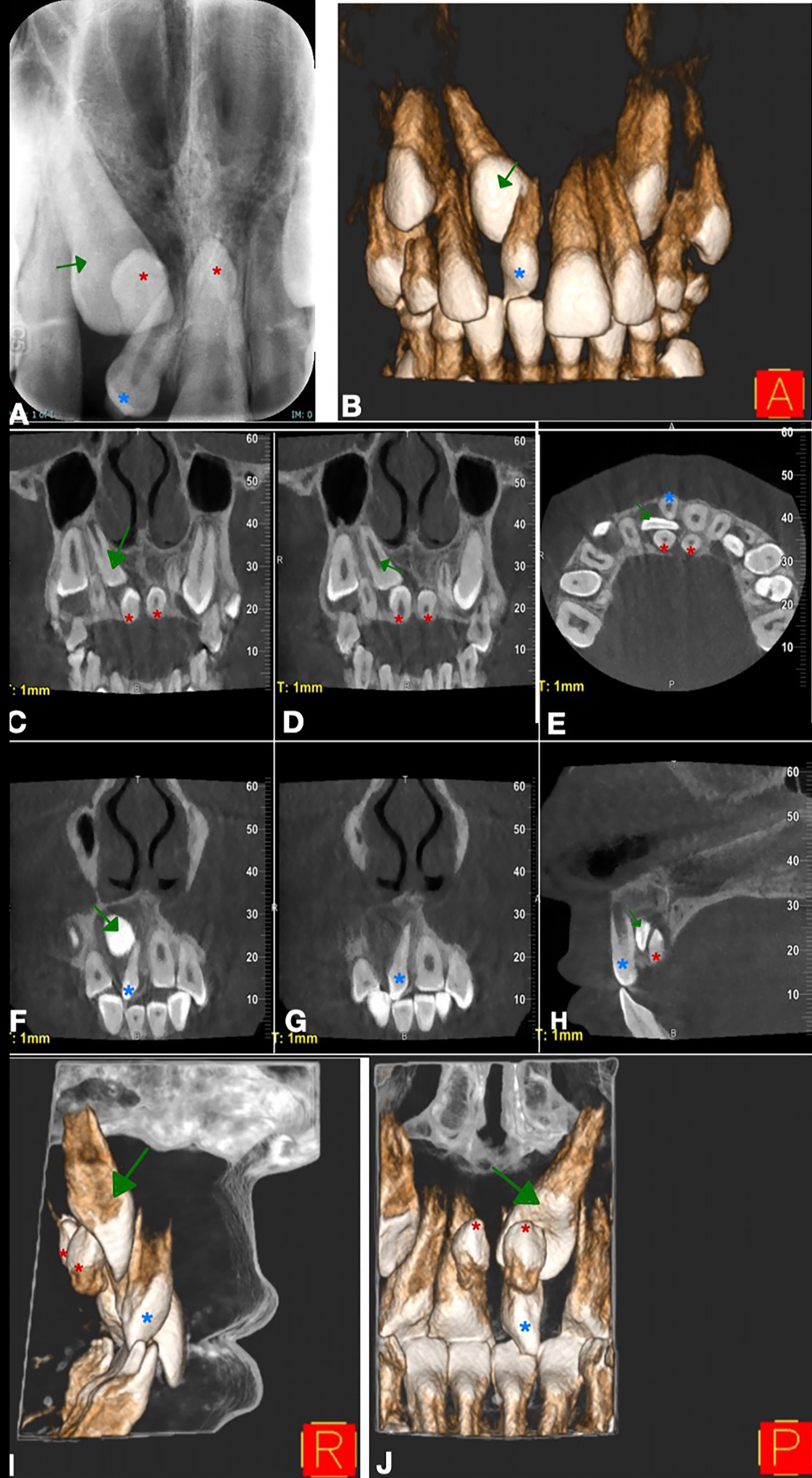 Radiographs of a sample case showing mesiodens causing 
complications (eruption problem, hyperplastic follicle) in permanent teeth. (A) 
Periapical radiographic image. The mesiodens in the buccal position (blue star) 
was clearly observed, but the mesiodens located in the palatal position (red 
stars) could not be clearly observed. (B) 3D reconstruction image. (C,D) Coronal 
CBCT image. (E) Axial CBCT image. A total of 3 mesiodens were observed, 1 (blue 
star) on the buccal and 2 (red stars) on the palatal of tooth number #11(green 
arrow). (F,G) Coronal CBCT image. (H) Sagittal CBCT image. (I) 3D reconstruction 
image (lateral). (J) 3D reconstruction image (posterior) (green arrows pointed to 
tooth #11, red and blue stars pointed at mesiodens).