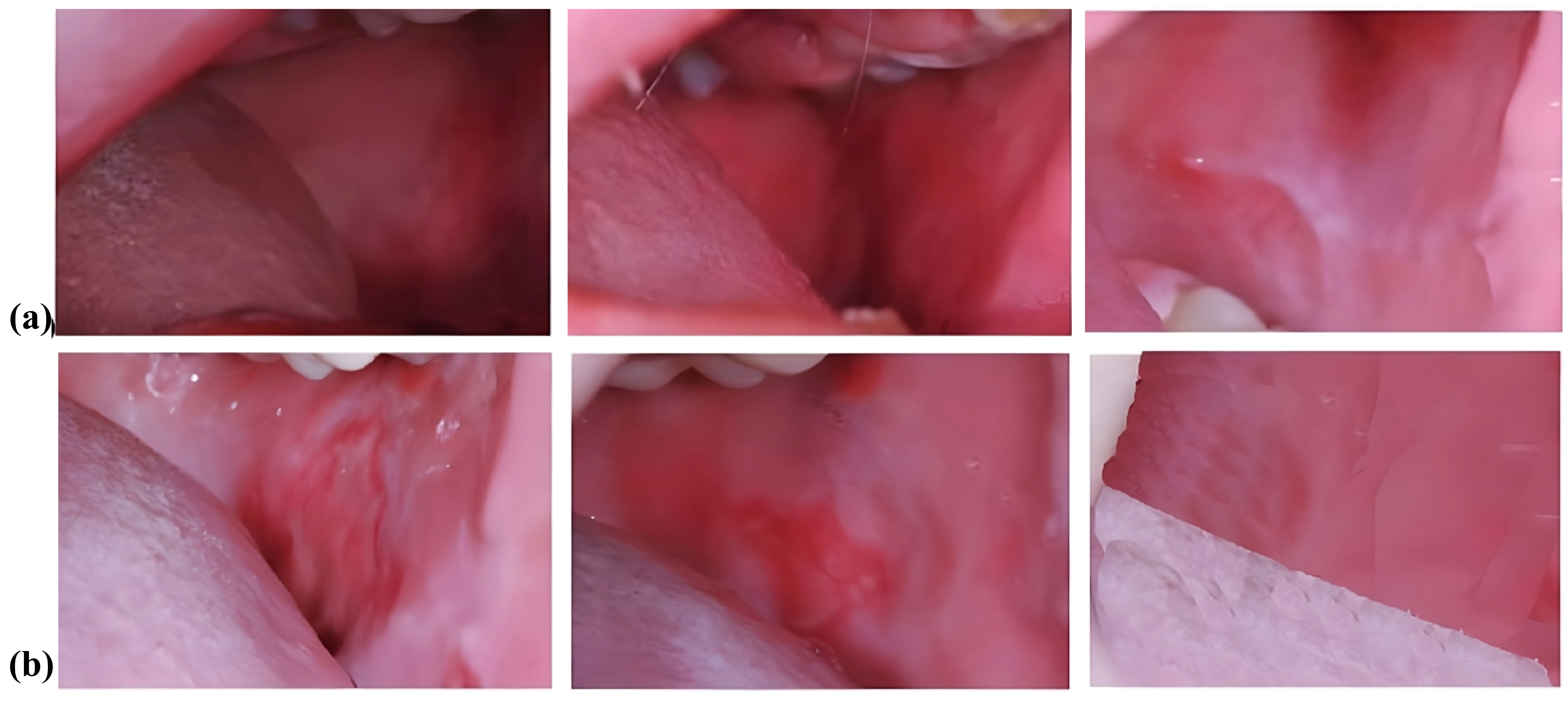 Clinical image displaying difference pre-treatment to 
post-treatment. Progressive improvement of oral mucositis in a pediatric patient 
treated with (a) photodynamic therapy; and (b) LL laser therapy, as observed on 
day 1, Day 4 and Day 7. Images demonstrate the gradual reduction in inflammation, 
erythema and ulcerations, with restoration of healthy mucosal tissue over time.
