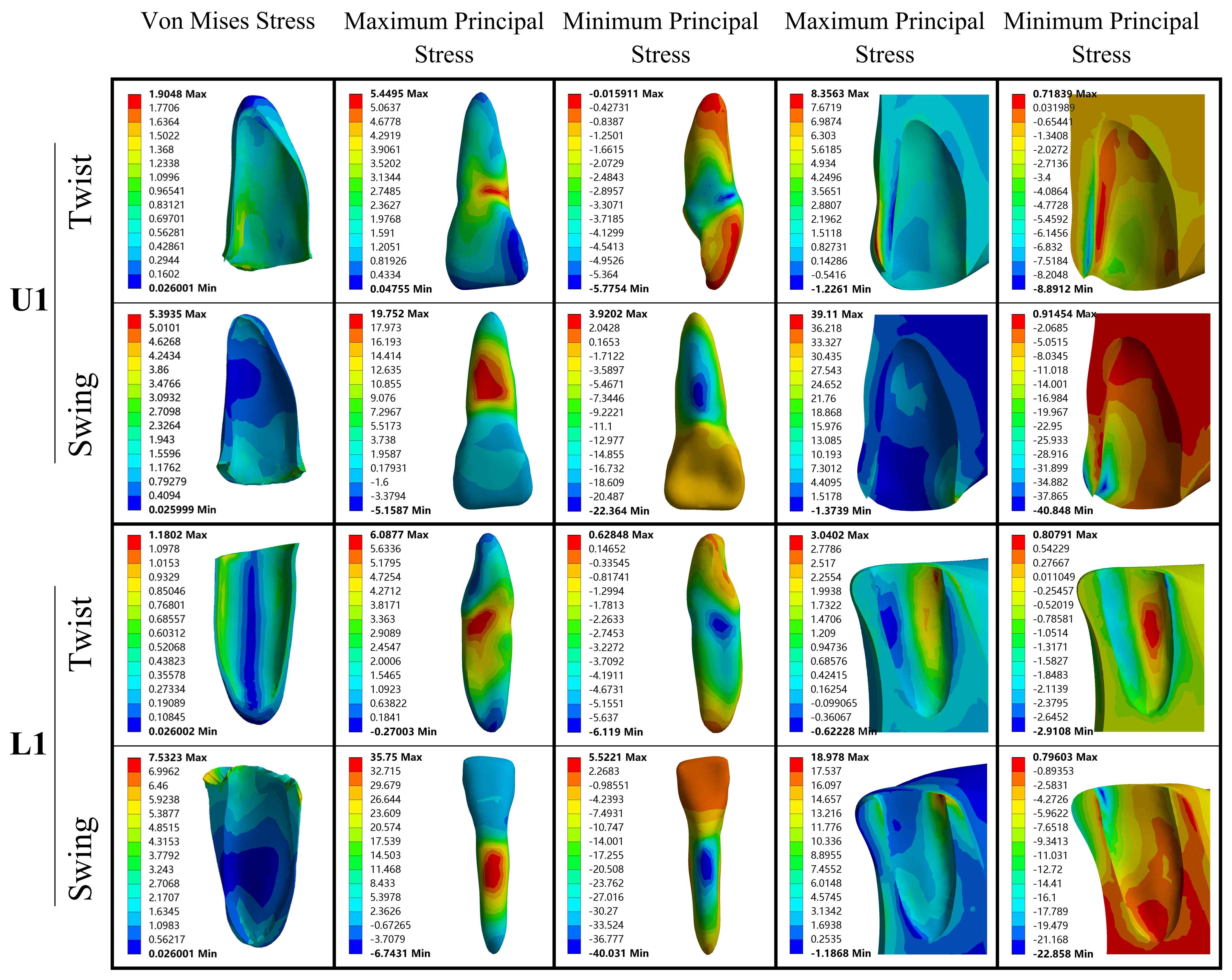 Stress distribution in U1 and L1. The figure illustrates the 
difference in stress distribution between the torsion and swing methods on the U1 
and L1 tooth-PDL-alveolar bone complex. U1: upper jaw incisor; L1: lower jaw 
incisor; Max: maximum; Min: minimum.