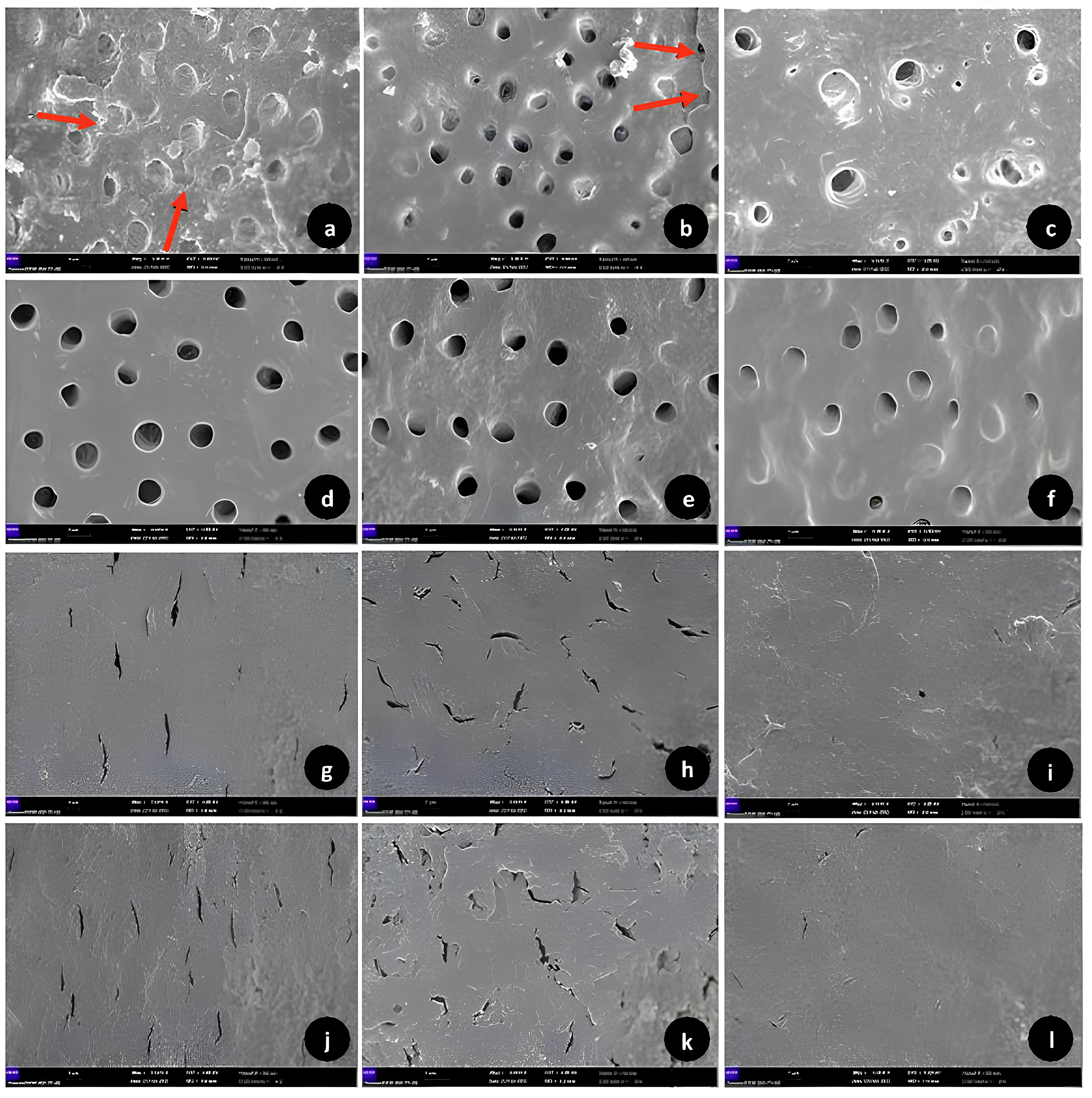 Representative SEM images (×3500 mag.) of the 
root surfaces of tooth samples from the ESXF group. Representative SEM images of 
root samples applied with 5% EDTA solution (a–c). Coronal third (a, score 1), 
middle third (b, score 1) and apical third (c, score 1). Erosive defects in 
inter- and peritubular dentin in coronal and middle thirds (a,b) are shown marked 
with red arrows. Representative SEM images of root samples applied with 6% CA 
solution (d–f). Coronal third (d, score 0), middle third (e, score 0) and apical 
third (f, score 1). Representative SEM images of root samples applied with 1% 
NaOCl solution (g–i). Coronal third (g, score 2), middle third (h, score 2) and 
apical third (i, score 2). Representative SEM images of root samples applied with 
0.9% PS solution (Control group) (j–l). Coronal third (j, score 2), middle 
third (k, score 2) and apical third (l, score 2).