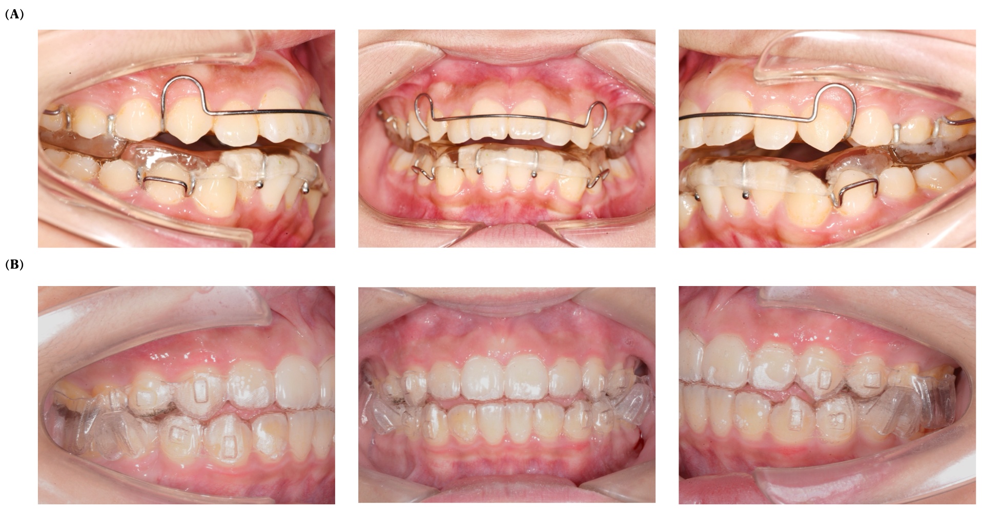 Intraoral views of twin-block (TB) 
appliance (A) and clear aligners with mandibular advancement (MA) (B) lateral and 
frontal perspectives.