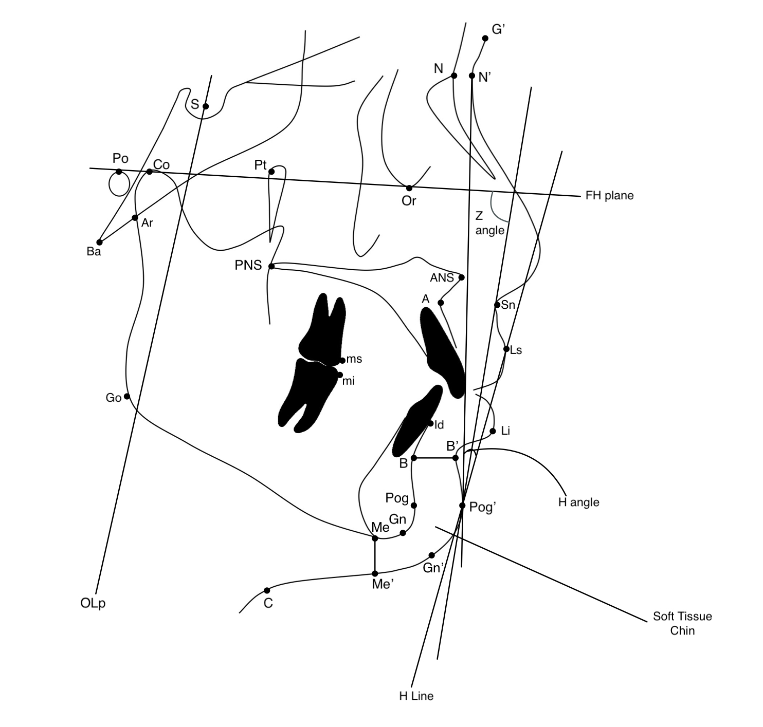 Landmarks, reference planes and 
cephalometric measurements applied in this study.