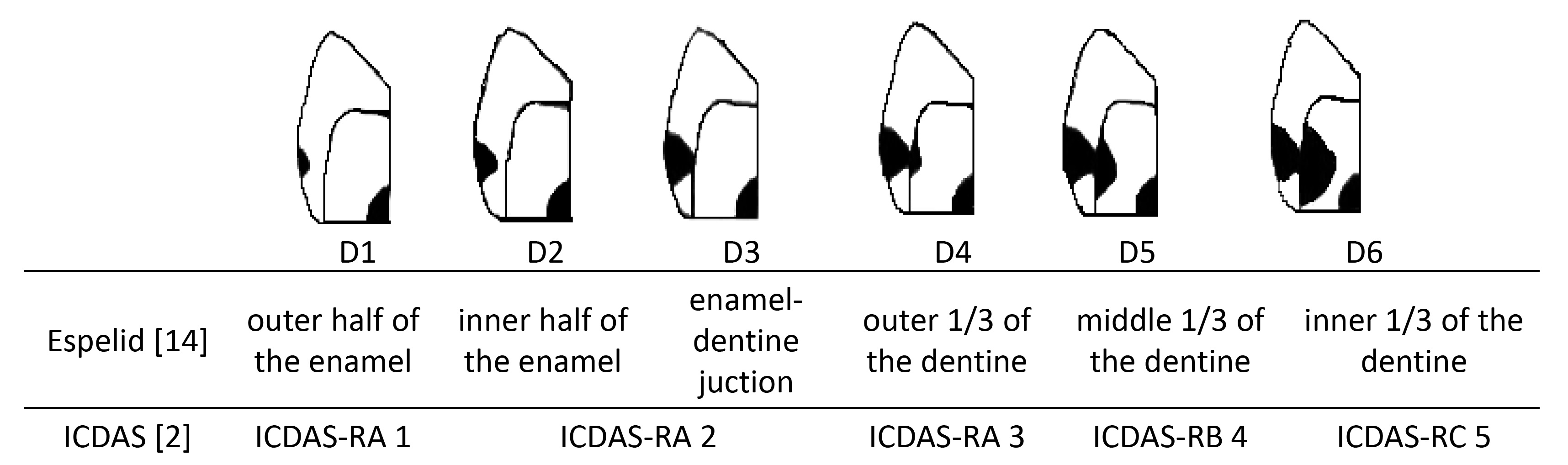 The proximal caries diagram according to the Espelid and ICDAS
classification. ICDAS: international caries detection and assessment system.