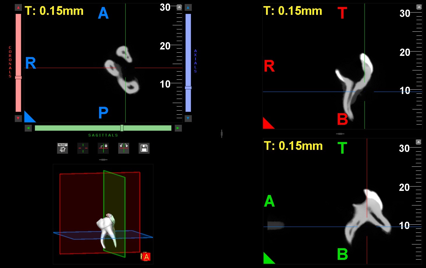 Coronal and axial section of the sample in the CBCT. A: 
Anterior; R: Right; P: Posterior; T: Top; B: Bottom.