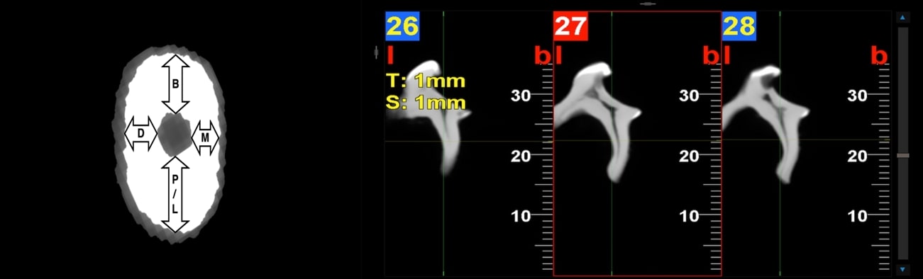 Linear measurements were made utilizing CBCT data and the 
vertical level of the root was determined in cross-sections. Dentin thicknesses 
were measured in the mesial, distal, buccal and lingual/palatinal direction in 
each horizontal section. T: Thickness; S: Space; b: Buccal.