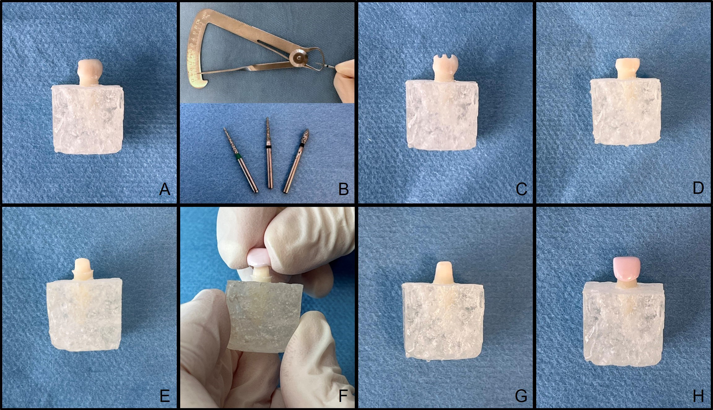 Preparation steps for PZCs. (A) Primary incisor tooth before 
preparation (B) Diamond burs used for preparation (C) Incisal depth cuts (D) 
Incisal preparation (E) Facial, interproximal and lingual shoulder preparation 
(F) Test fitting before subgingival preparation (G) Subgingival feather-edge 
preparation (H) Final test fitting.