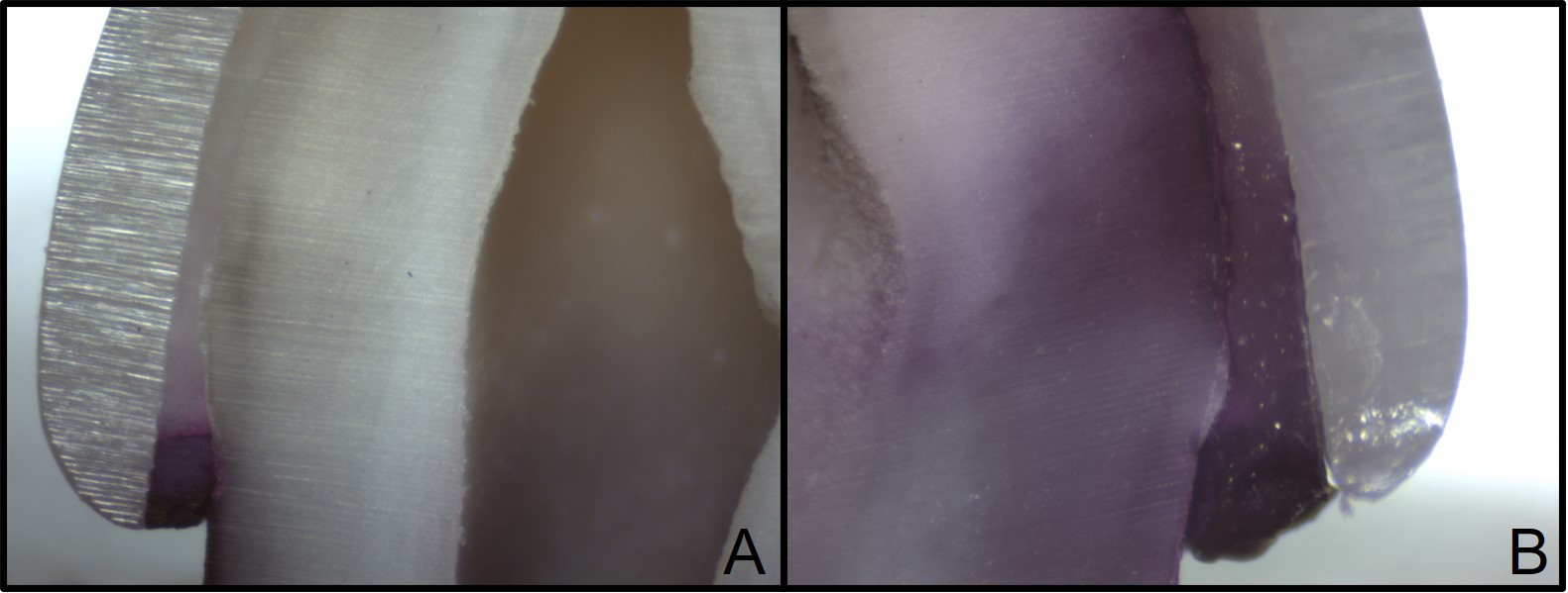 Representative microscopic images taken from sections at 
30× magnification. (A) Score 0: Dye penetration at crown margins only. 
(B) Score 4: Dye penetration throughout tooth structure and pulp.