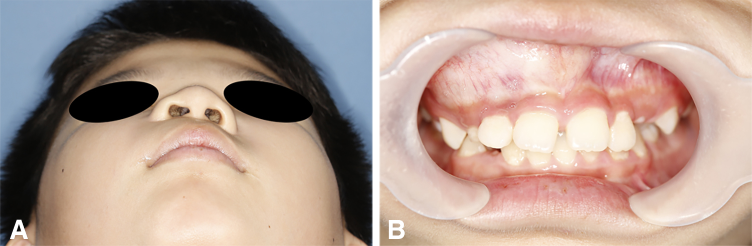 Clinical images of patient 1. (A) Extraoral images: The patient
exhibited significant facial swelling with elevation of the alar base on the
right cheek. (B) Intraoral image: Vestibular swelling of the right maxilla is
evident, along with distoangulation of teeth #11 and #12. No notable signs of
mucosal inflammation are observed.