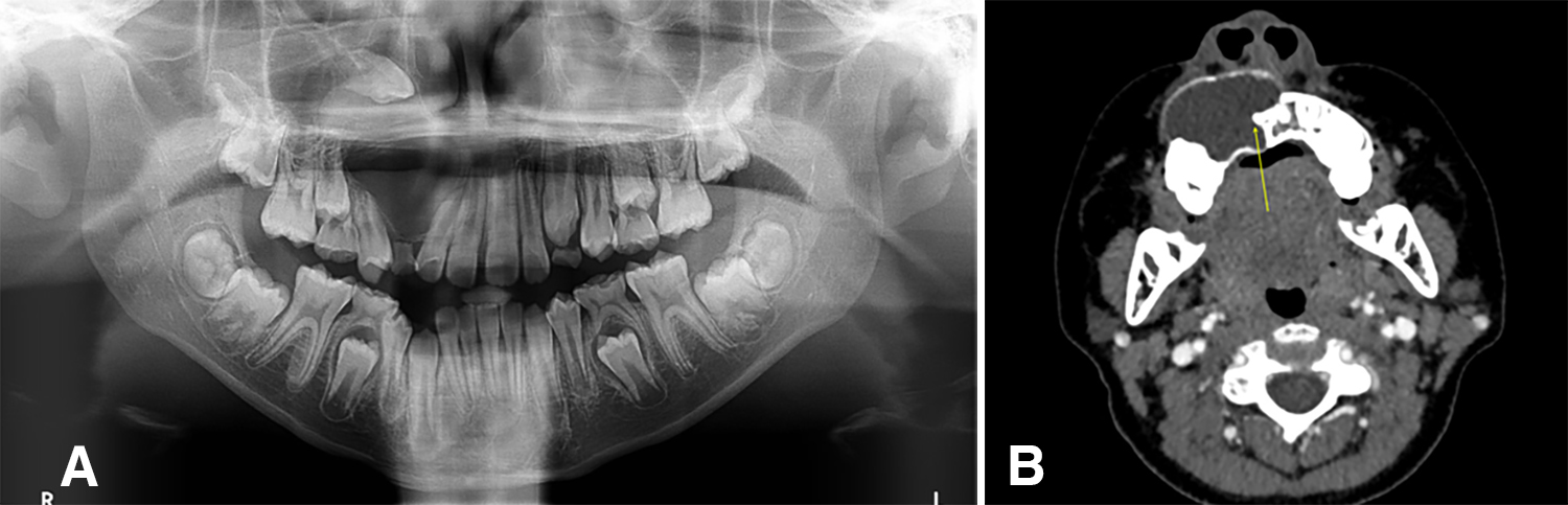 Preoperative radiographic evaluation. (A) Panoramic X-ray
image: Radiographic image showing the impacted right maxillary canine displaced
superiorly, associated with a well-defined cystic lesion. Dental inclination of
adjacent teeth #11, #12 and #14 is noted. (B) PNS contrast CT image: It
reveals a large cystic lesion involving the impacted right maxillary canine
(yellow arrow), along with expansion and thinning of the labial bone.