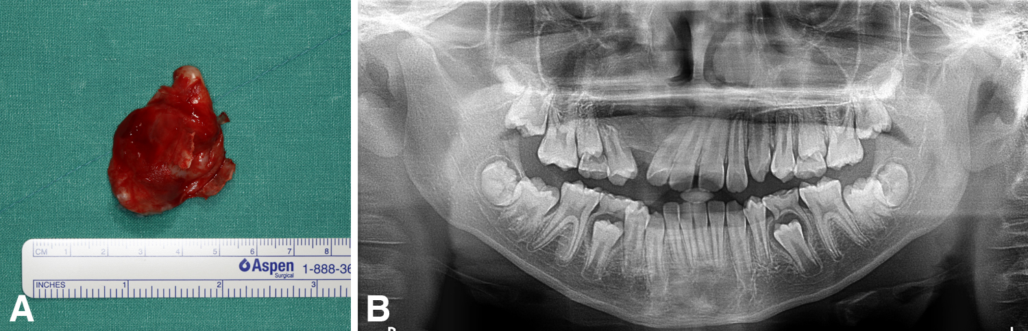 Immediate postoperative figures. (A) Gross specimen:A
well-demarcated cystic lesion was excised intact without rupture, encapsulating
the impacted maxillary canine. (B) 6-month post-operative panoramic X-ray image:
The cystic mass and impacted canine were successfully removed, and the bony
defected was filled with allograft bone materials. The inclination of adjacent
teeth remained evident.
