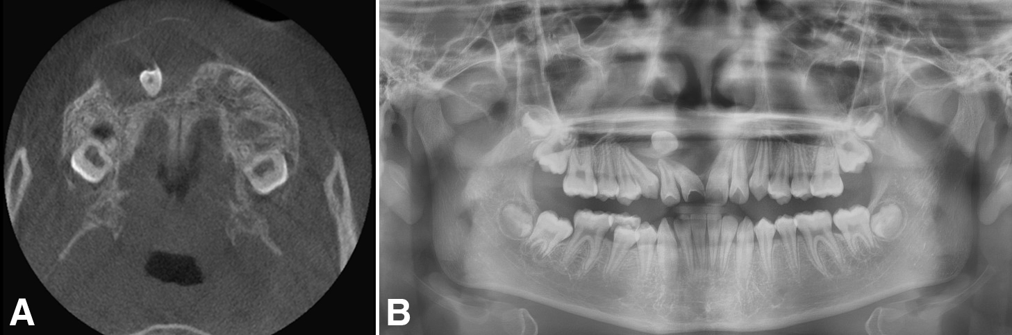 Preoperative radiographic evaluation. (A) Panoramic X-ray image
and (B) cone-beam computed tomography (CBCT) axial view: Radiographic examination
reveals a well-demarcated radiolucent lesion on the right maxilla surrounding an
impacted canine. Root inclination of adjacent teeth is observed on the right
maxillary incisors and canine, due to cystic mass expansion.