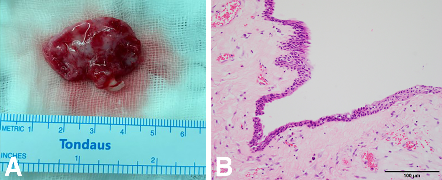 Representative gross and histological images of a dentigerous
cyst. (A) Gross specimen: Excised cystic mass with an intact boundary, measuring
approximately 3 cm, containing a supernumerary tooth. (B) Histopathological
examination with hematoxylin and eosin (H&E) staining: Cystic lining epithelium
with a fibrous connective tissue wall, consistent with a dentigerous cyst.
