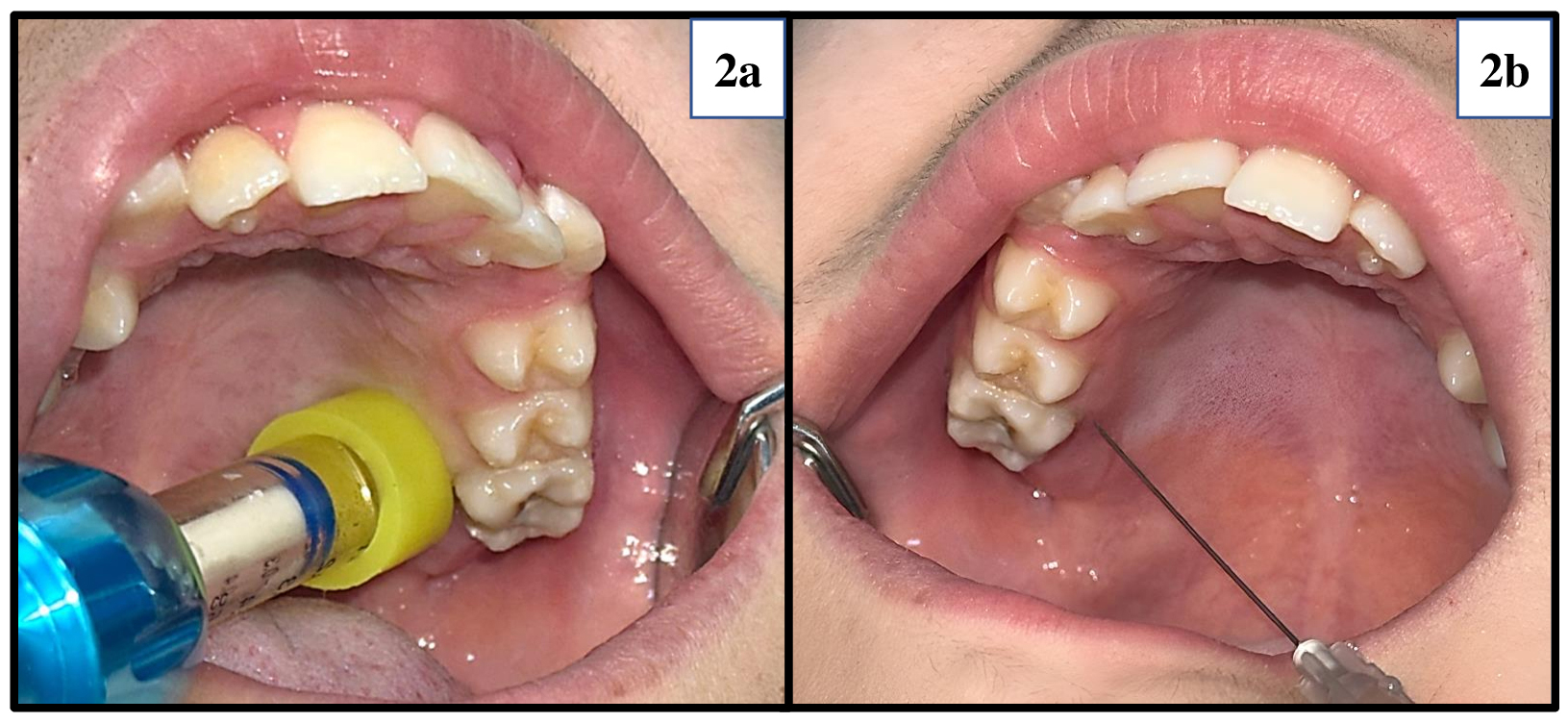 Application of the two injection methods. (a) Application of
Comfort-In™ injection system. (b) Application of dental needle.
