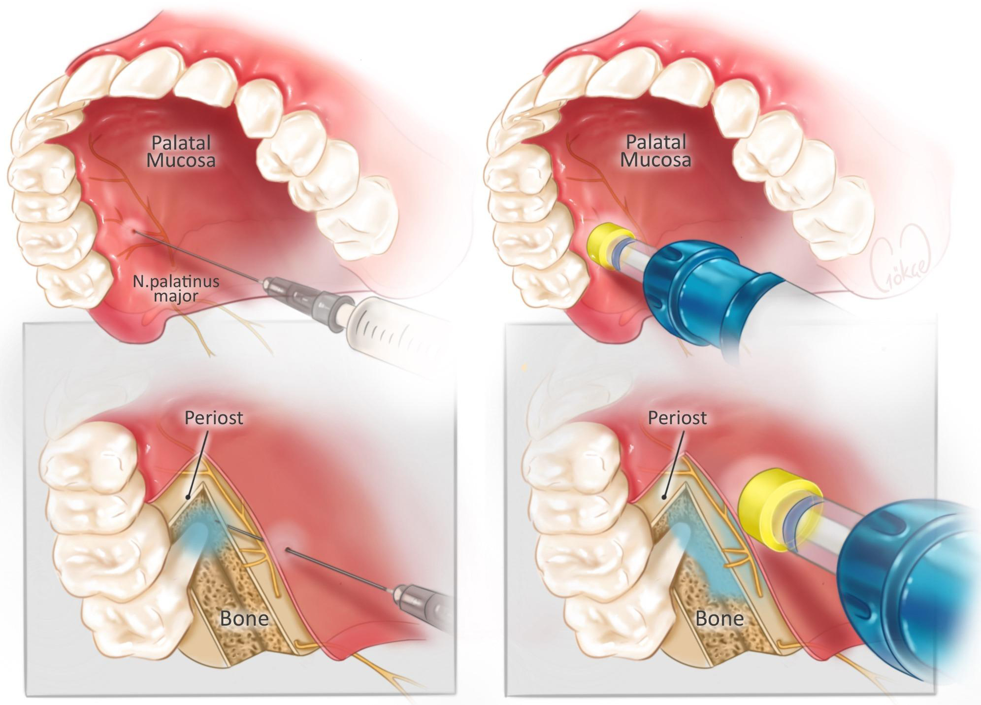 Diagrammatic presentation of Comfort-In™
injection system and dental needle injection during palatal anesthesia.