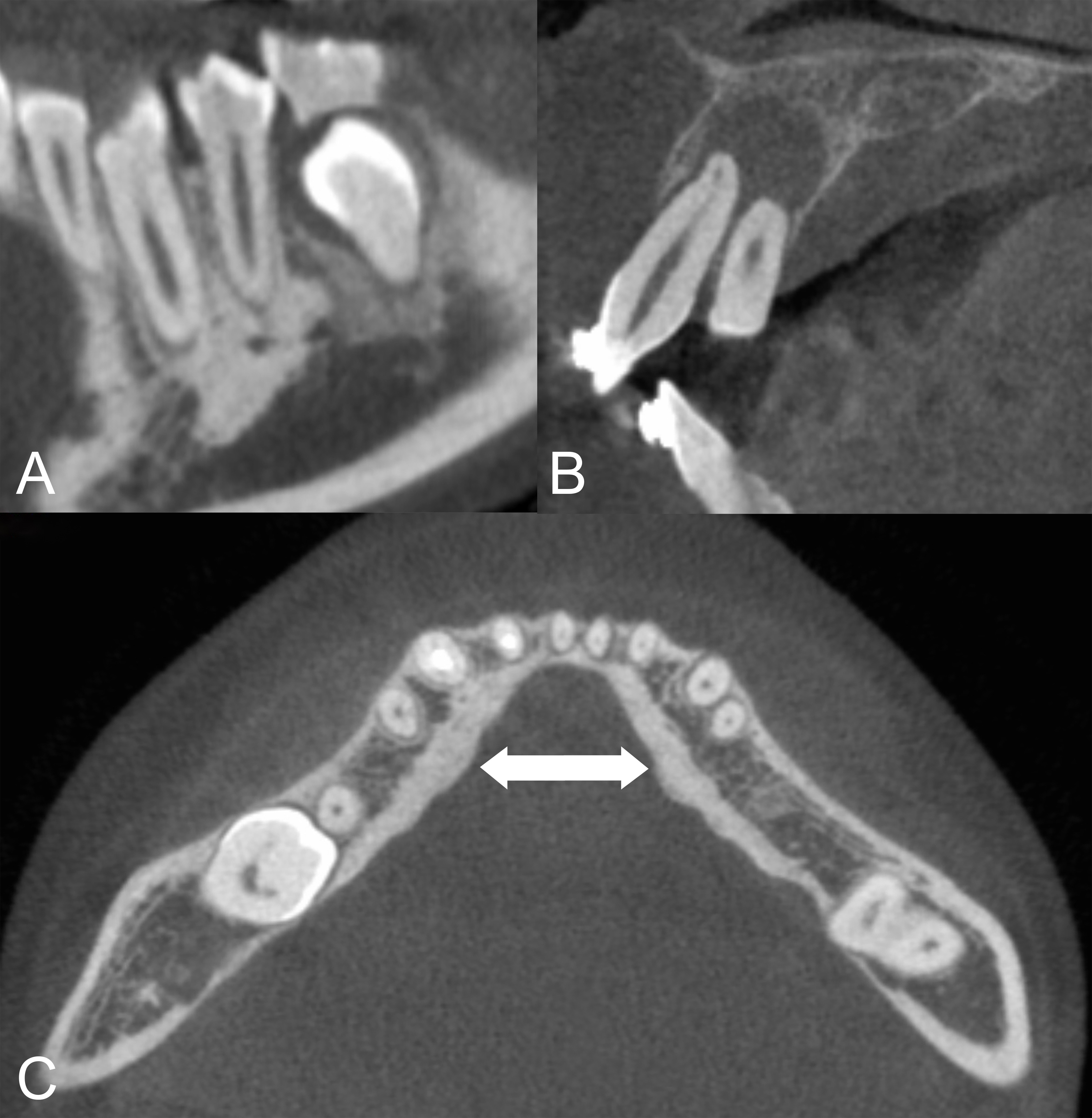 Representative cone beam computed tomography (CBCT)
findings of bone structure and jaw lesions. (A) In the sagittal CBCT image;
osteosclerosis is apparent in the area around teeth 33 and 34. (B) In the
sagittal CBCT image, a radicular cyst is seen in tooth 21. (C) The axial CBCT
image shows bilateral multiple mandibular torus.