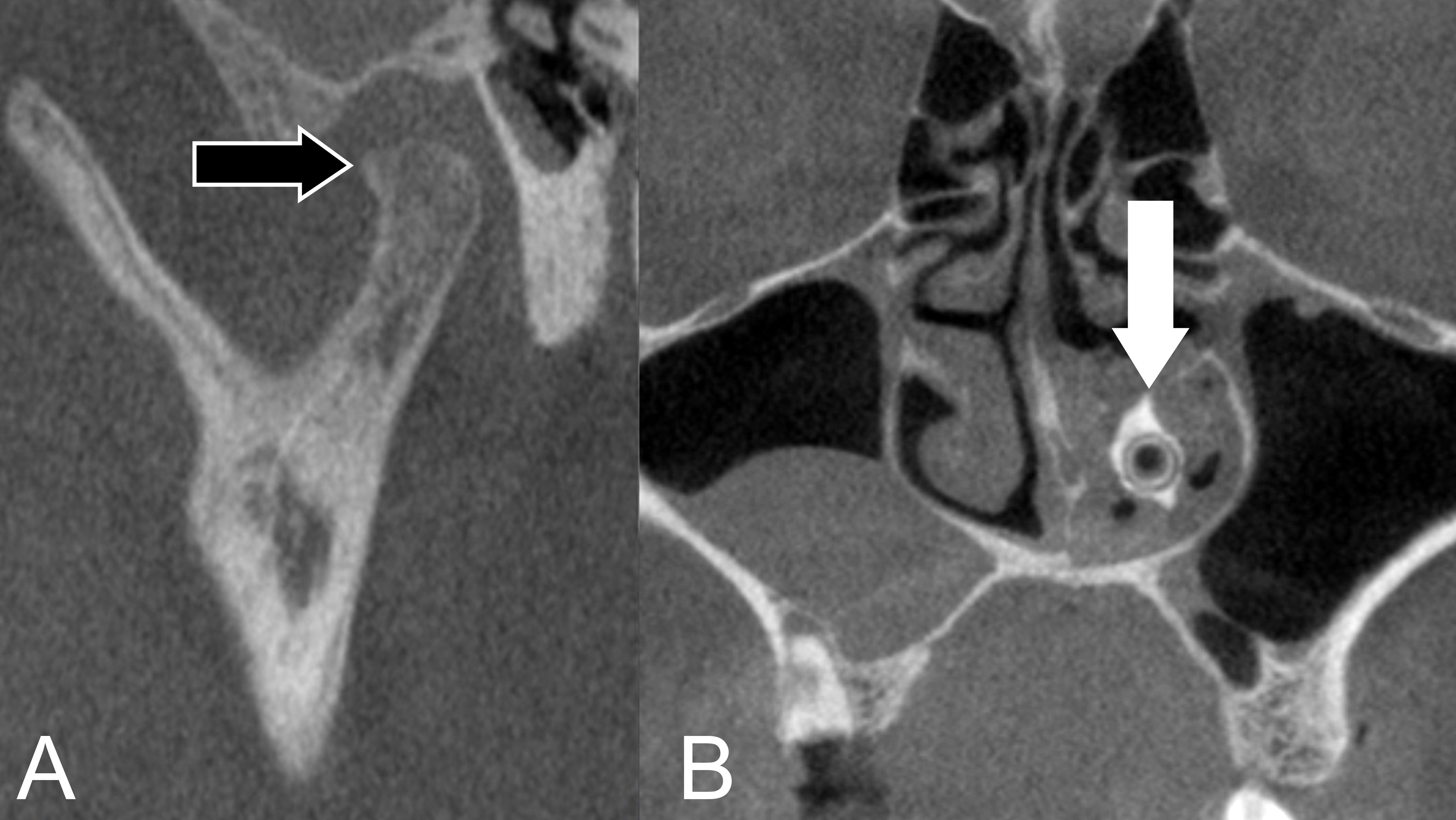 Representative cone beam computed tomography (CBCT) findings of
temporomandibular joint and nasal cavity. (A) In the sagittal CBCT image, the
arrow indicates the osteophyte of the condyle. (B) In the coronal CBCT image, the
arrow indicates the rhinolith in the left nasal cavity.