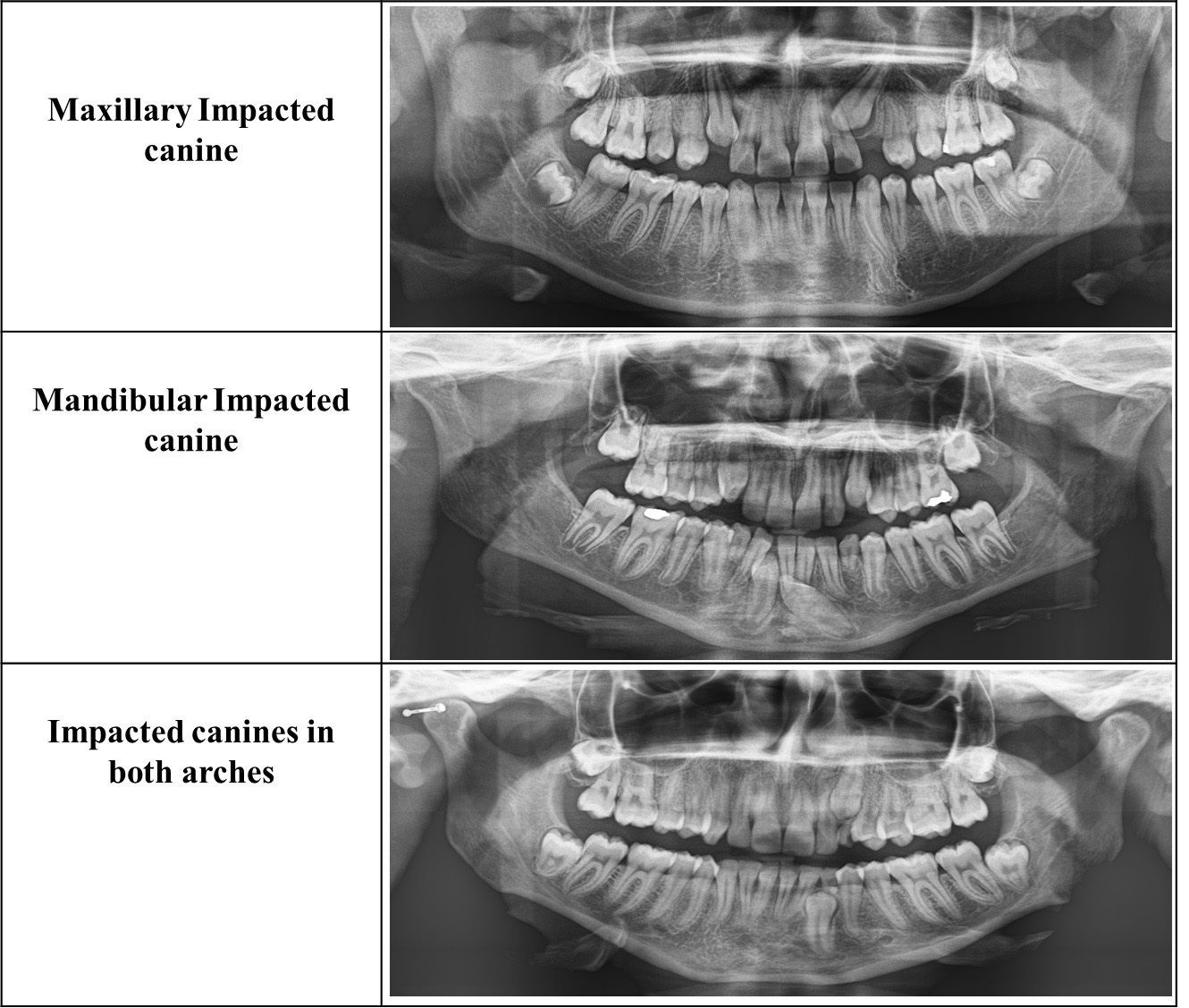 Clinical cases of impacted canines, in relation to 
their position in the arch.