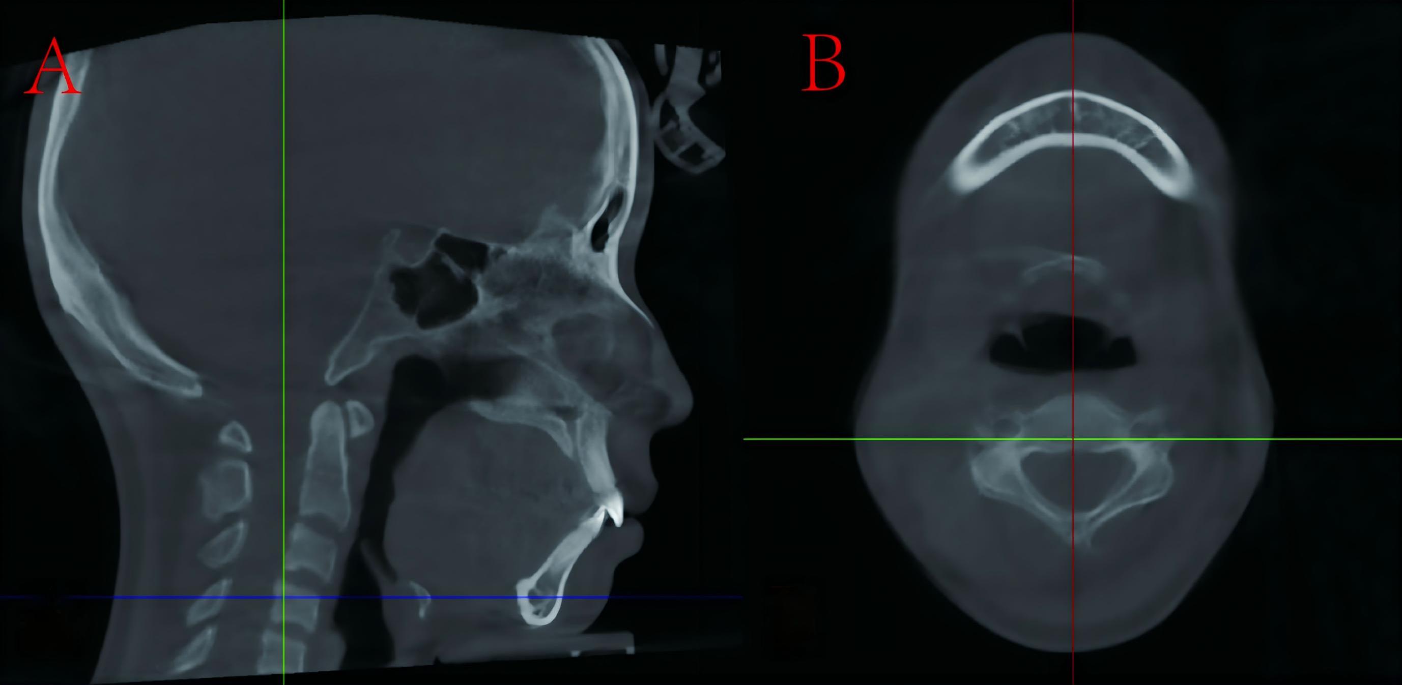 Determining the midsagittal plane of the mandible. (A) The blue 
line is parallel to the FH plane and passes through point Pog. (B) The red line 
crosses the widest anterior and posterior distance in the middle of the mandible.
