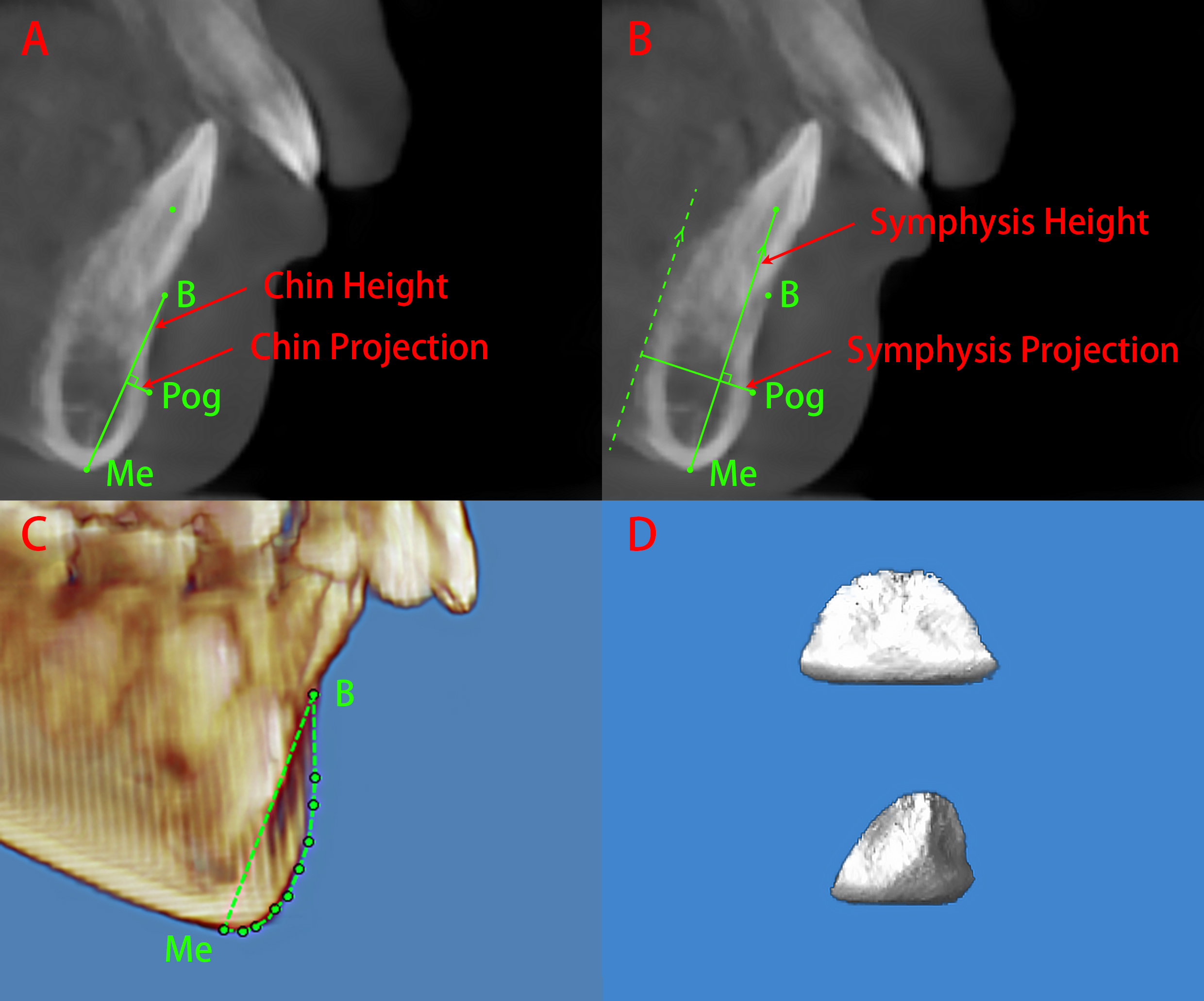 Chin and symphysis measurements. (A) Chin linear measurements: 
chin projection, chin height. (B) Symphysis linear measurements: symphysis 
projection, symphysis height. (C) Delimitation of chin volume. (D) 3D image of 
chin volume: front view and 45-degree profile view. Pog: Pogonion; Me: Menton.