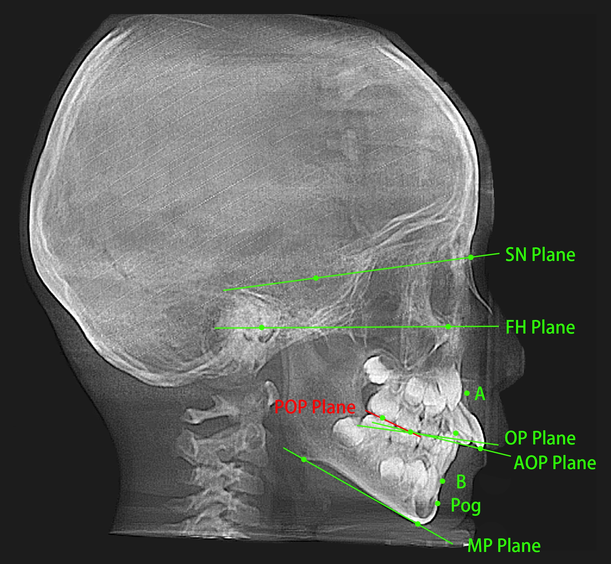 Landmarks and planes. POP: posterior occlusal plane; OP: the 
occlusal plane; AOP: anterior occlusal plane; Pog: Pogonion; MP: Mandibular Plane 
angle; SN: Sella-Nasion plane; FH: Frankfort Horizontal plane.
