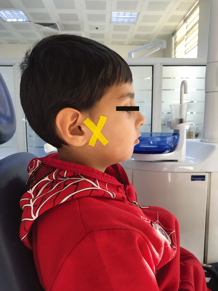 Kinesio tape application in a child.