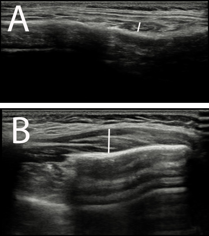 Masseter and temporalis superficialis muscles, the widest
distance between the superficial and deep fascia for both muscles was measured in
the axial plane. (A) Masseter. (B) Temporalis superficialis.
