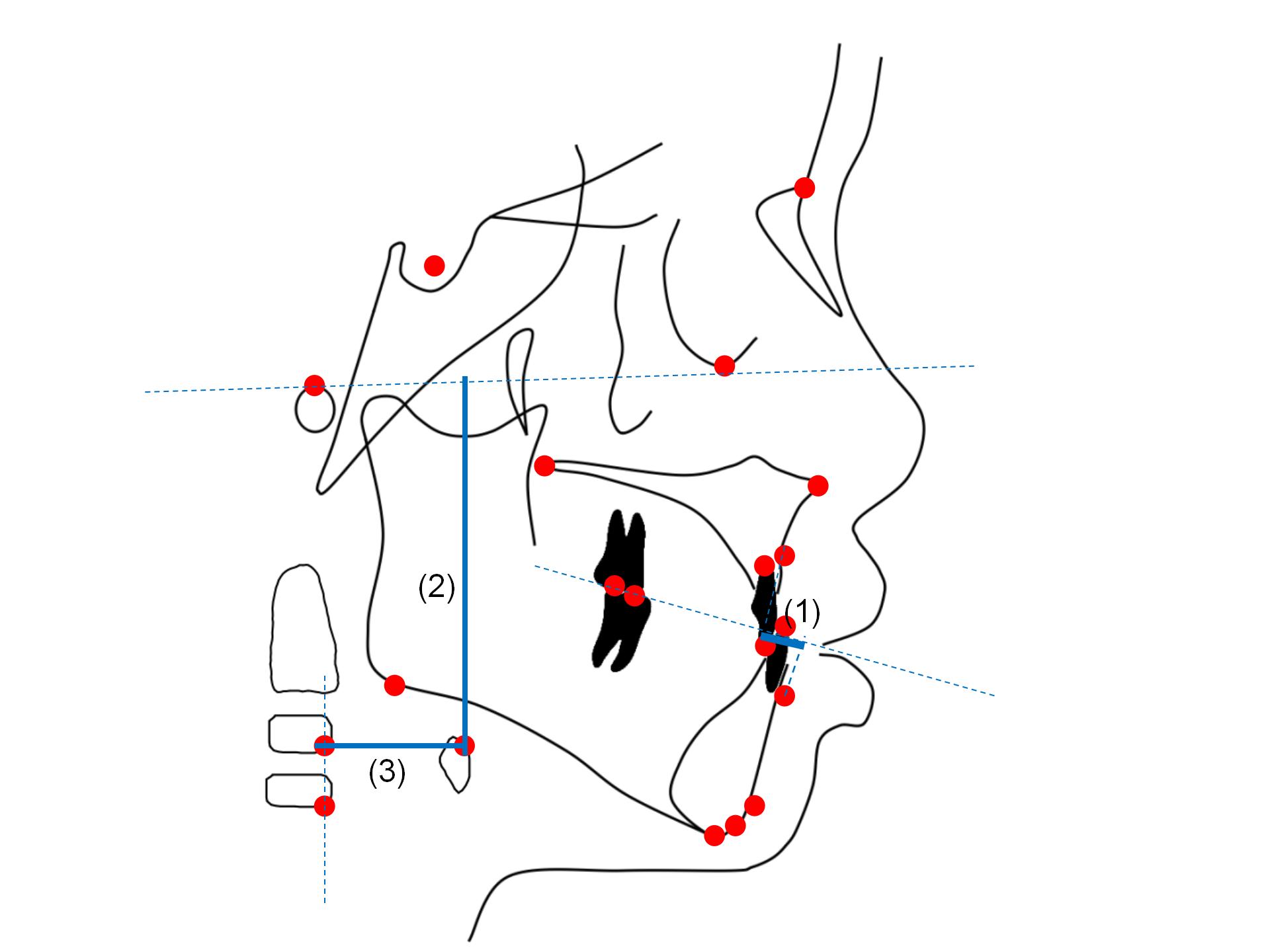 Linear measurements. (1) Wits; (2) H-FH and (3) H-CVP.