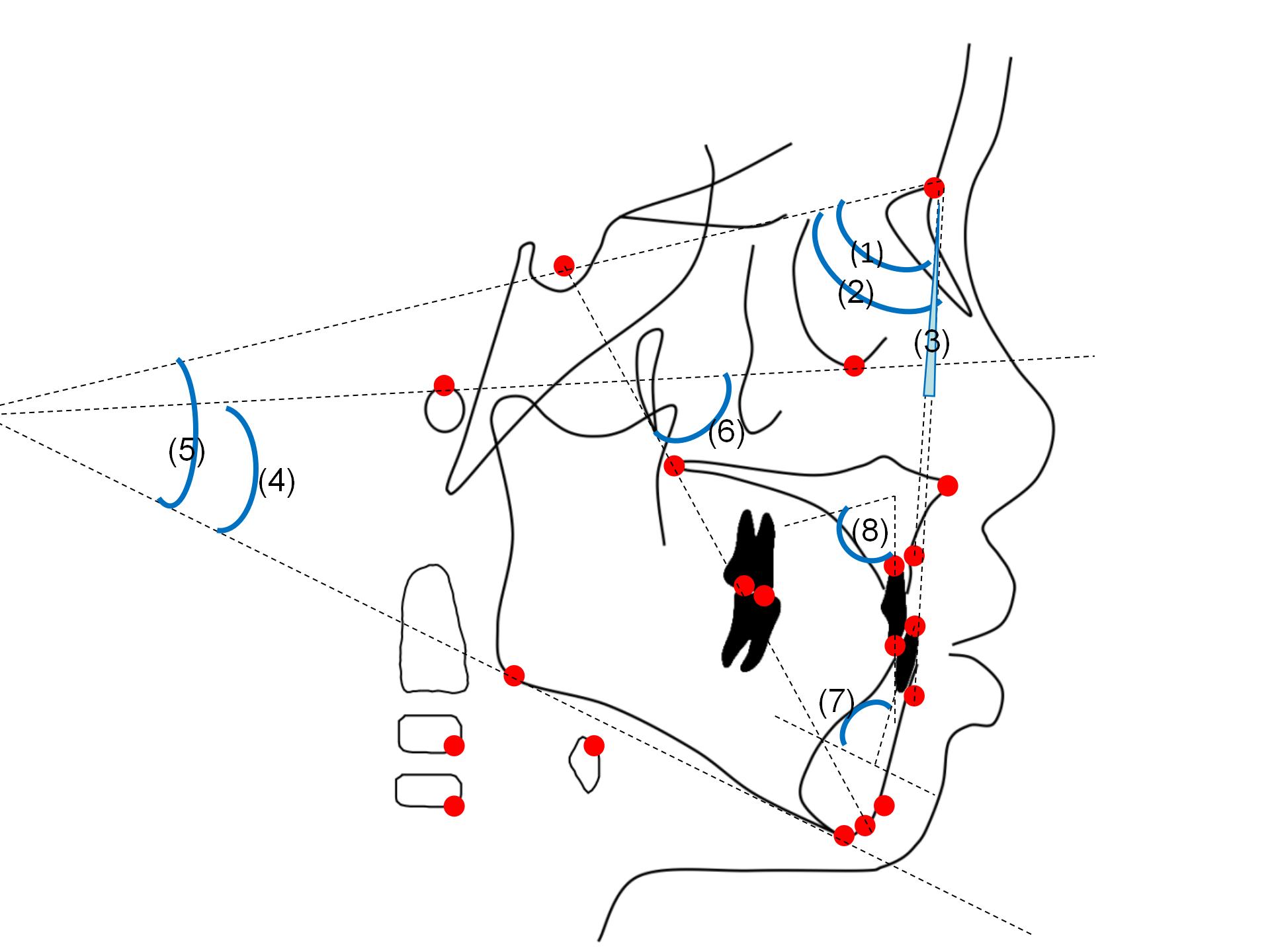 Angular measurements. (1) SNA; (2) SNB; (3) ANB; (4) FMA; (5)
SN-MP; (6) SGn-FH; (7) L1-MP and (8) U1-SN angles.