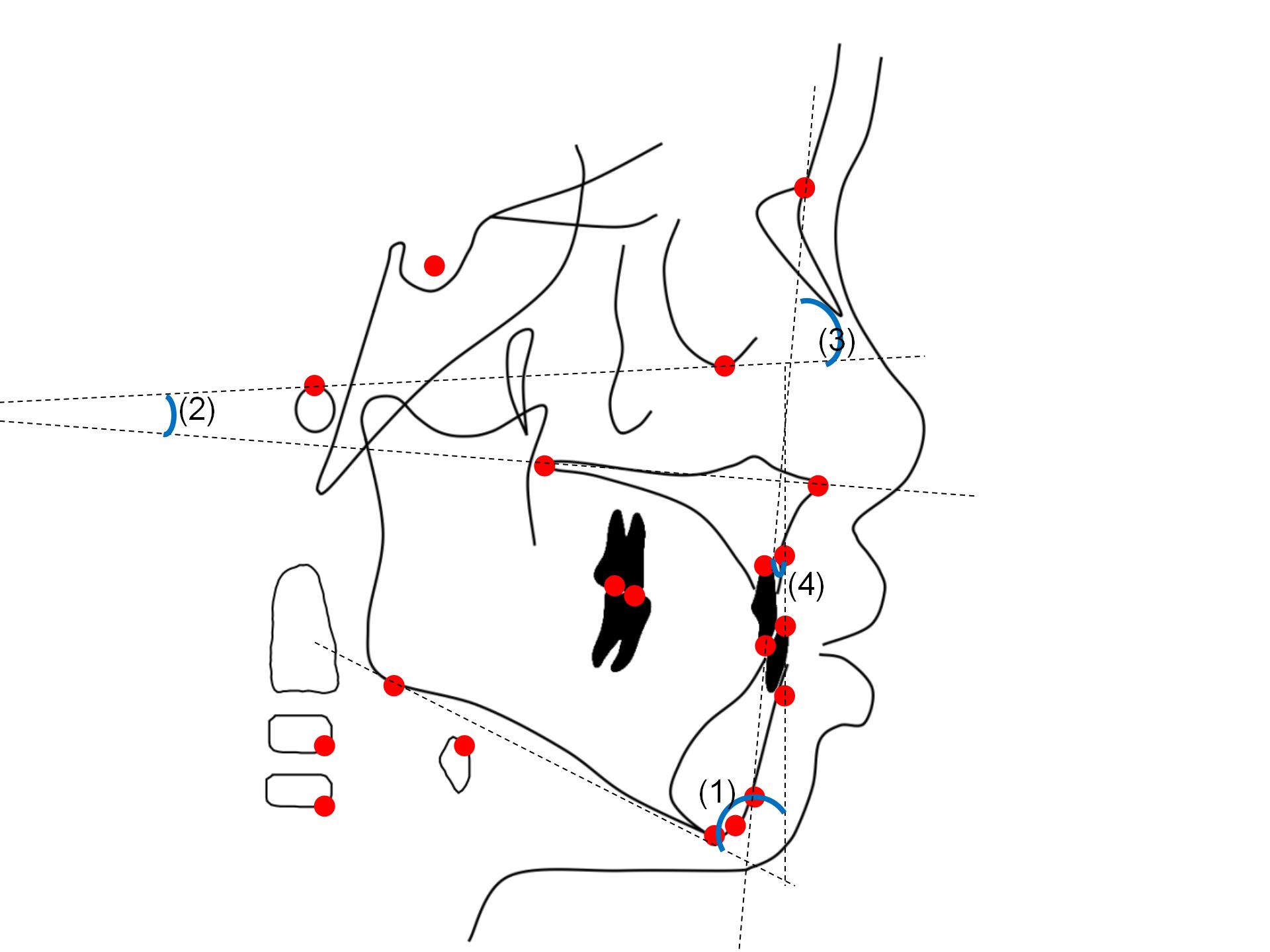 ODI and APDI measurements. (1) AB-MP; (2) PP-FH; (3) FH-NPg and
(4) AB-NPg.