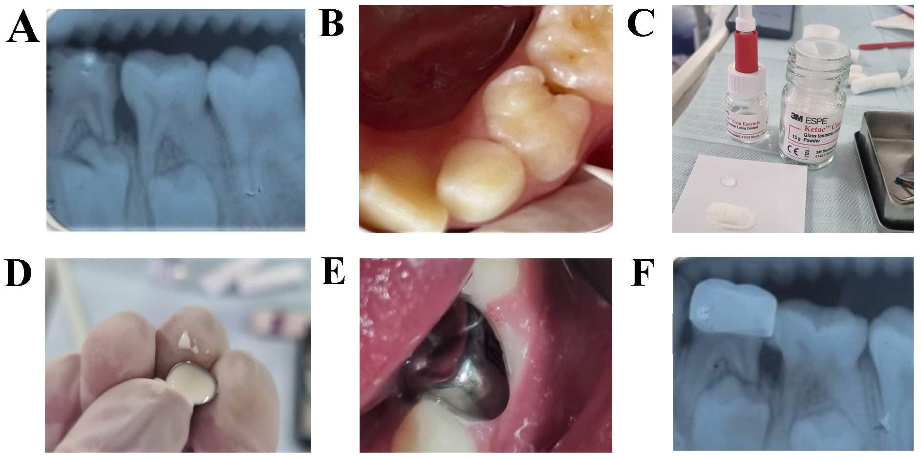 Clinical sequence of the hall technique placement. (A)
Radiograph of the carious lesion on tooth 74. (B) Prophylaxis on tooth 74. (C)
Manipulation of the Ionomer. (D) Placement of the Ionomer in the Hall crown. (E)
Installation of the crown. (F) Radiograph after installation.