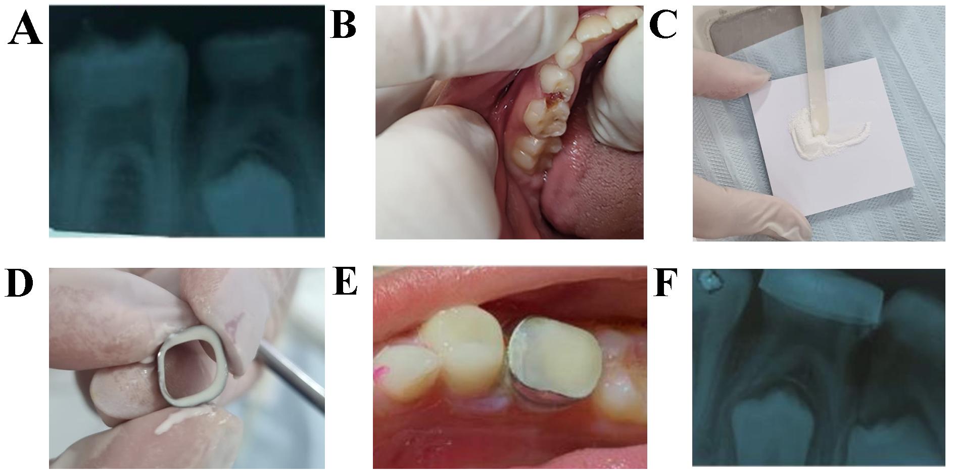 Clinical image sequence of orthodontic band installation
(BGIC). (A) Initial radiograph of tooth 64. (B) Places caries lesion score 5
after prophylaxis. (C) Manipulation of the Ionomer. (D) Placement of the Ionomer
in the orthodontic band. (E) Installation of the band on the tooth. (F)
Radiograph after installation.