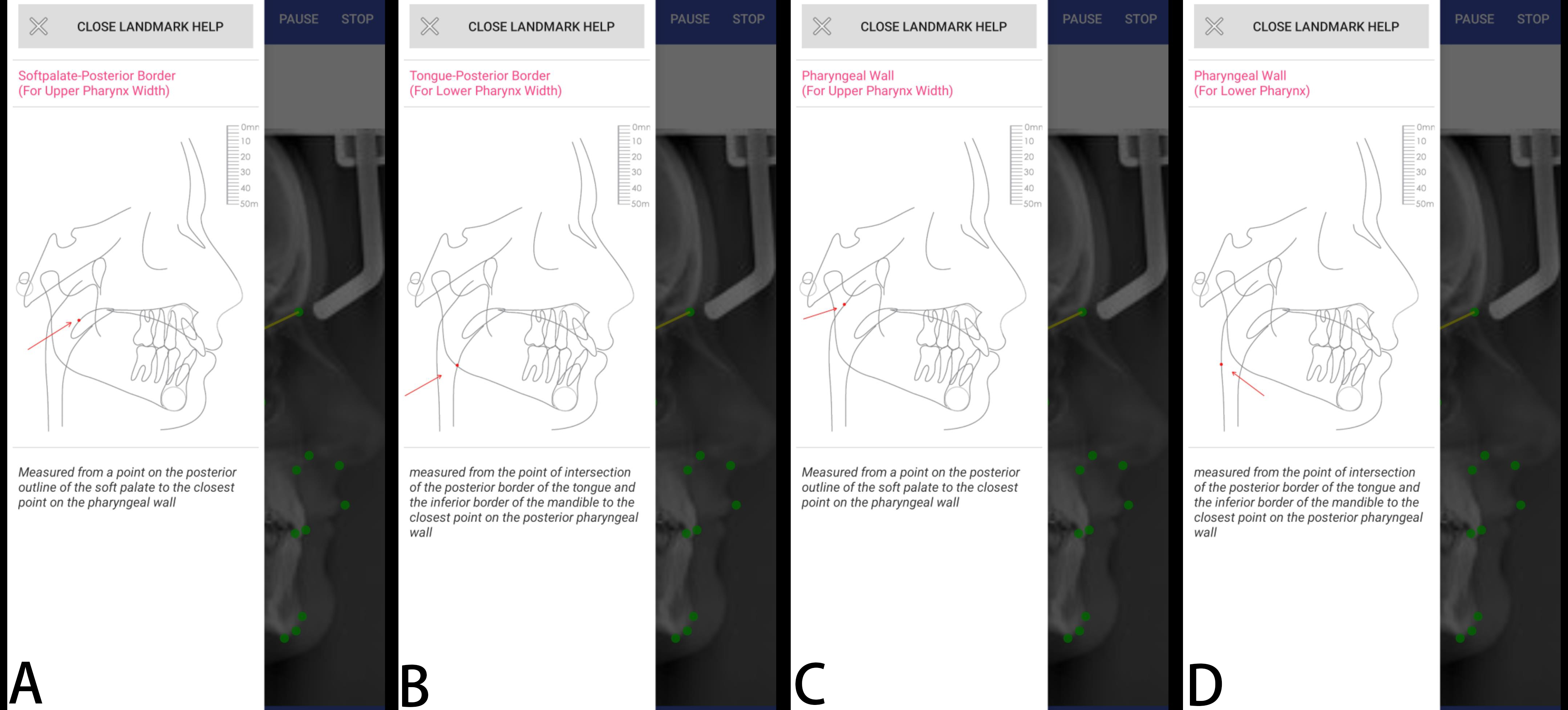 Cephalometric points used in the study. (A) soft palate, (B)
tongue posterior, (C) pharyngeal wall for upper pharynx, (D) pharyngeal wall for
lower pharynx.