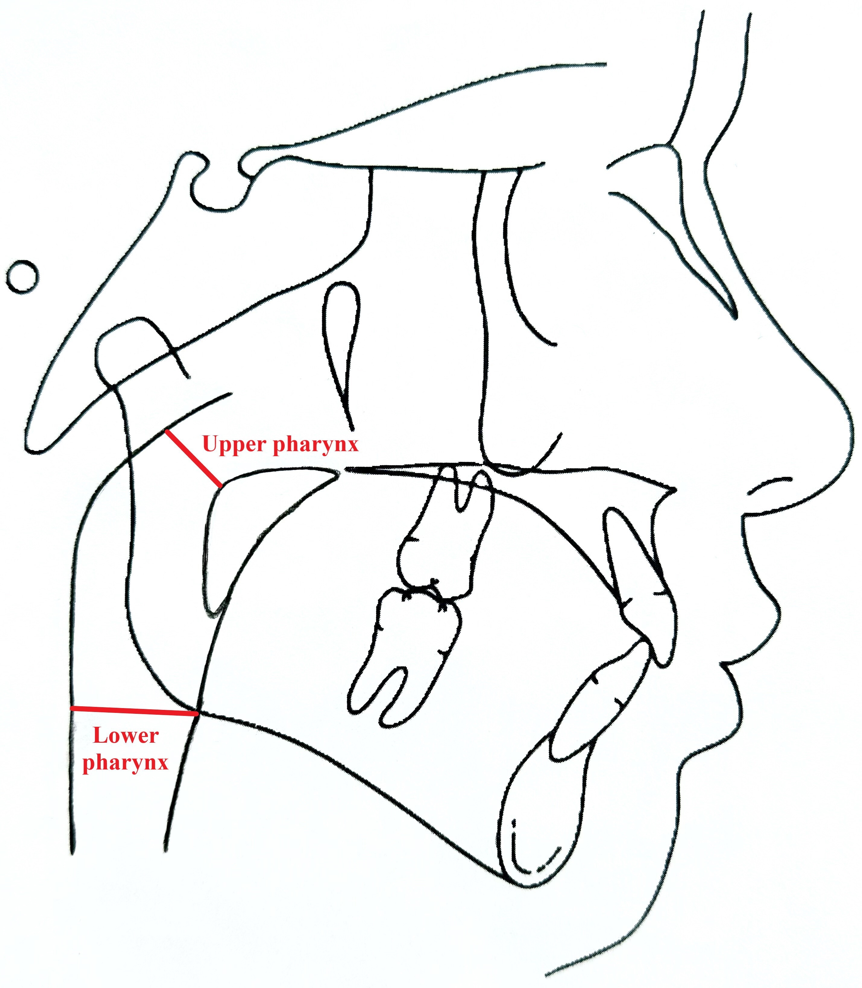 Manual cephalometric analysis of upper and lower pharynx.