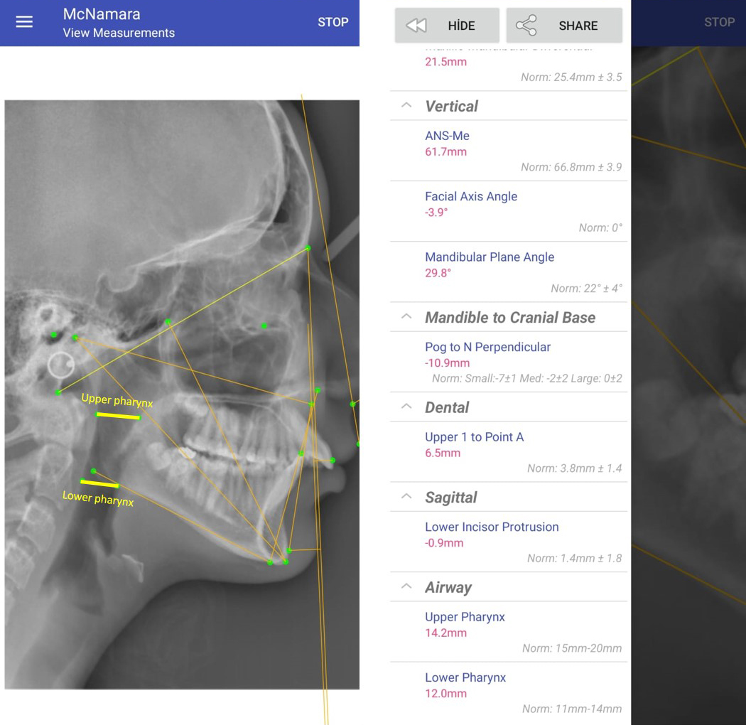 Screen image of app-aided OneCeph cephalometric analysis.