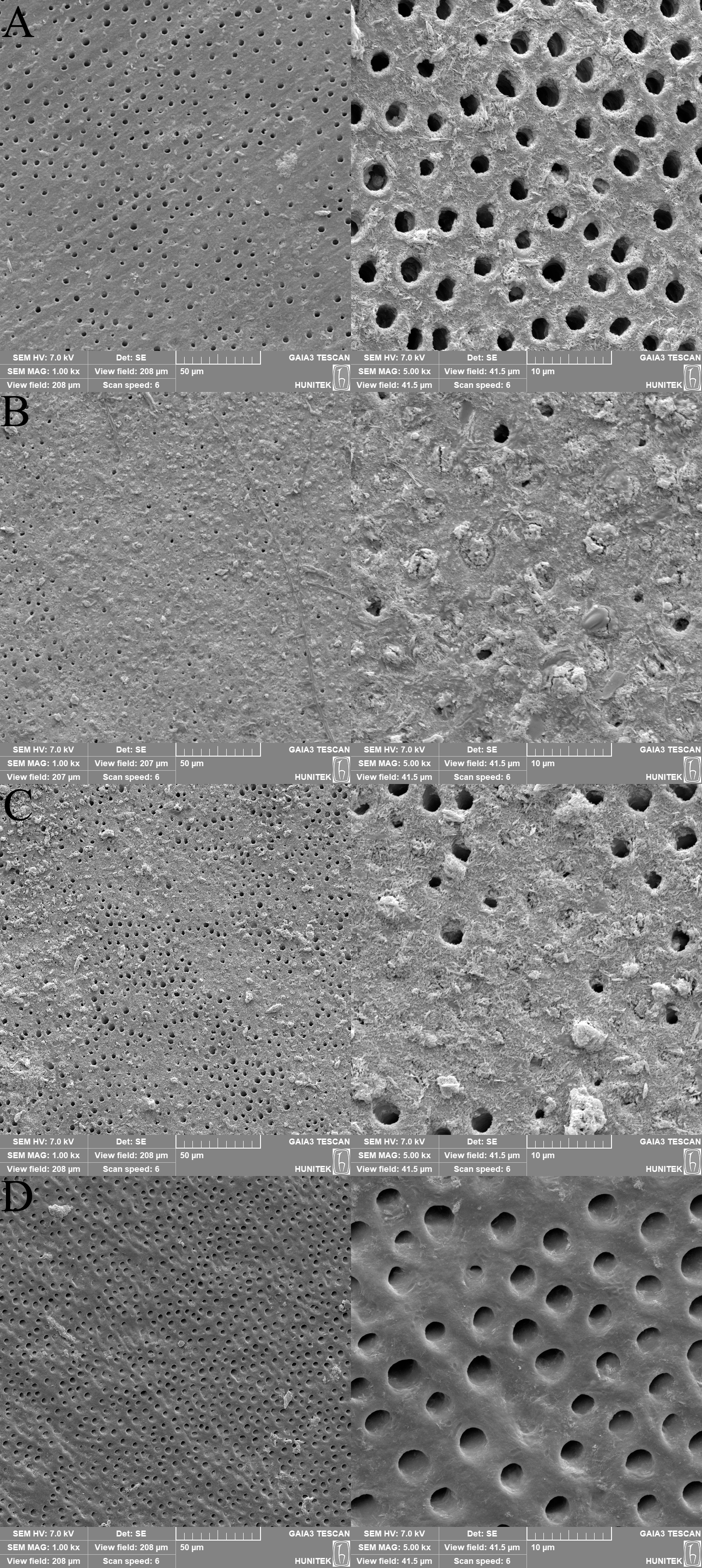 SEM images of the groups in the study. In the P11-4 group,
shown in (A), narrowing of the intertubular dentin and the formation of
fibrillar, fiber-like skeletal structures were observed, indicating early-stage
collagen-guided remineralization. The SDF group (B) displayed predominantly
occluded dentinal tubules, along with a dense and granular surface morphology
suggestive of silver compound deposition and advanced mineral infiltration. In
the fluoride varnish group, seen in (C), the dentinal tubules appeared partially
occluded, with a visible reduction in tubule diameter and a smoother surface
compared to the control group, indicating a moderate degree of surface
remineralization. In contrast, the negative control group (D) exhibited irregular
and deformed dentinal tubule lumens, reflecting substantial mineral loss without
signs of structural recovery. These morphological differences are visually
represented in Fig. 2, with each group shown at ×1000 (left) and
×5000 (right) magnification. SEM: scanning electron microscopy.